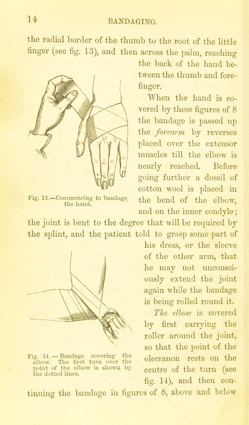 the radial border of the thumb to the root of the little finger (see fig. 13), and then across the palm, reaching the back of the hand be- tween the thumb and fore- finger. When the hand is co- vered by these figures of 8 the bandage is passed up the forearm by reverses placed over the extensor muscles till the elbow is nearly reached. Before going further a dossil of cotton wool is placed in Fig. 13. Commencing to bandage t]ie bend 0f tllO elboW, and on the inner condyle; the joint is bent to the degree that will be required by the splint, and the patient told to grasp some part of his dress, or the sleeve of the other arm, that he may not unconsci- ously extend the joint again while the bandage is being rolled round it. The elboiv is covered by first carrying the roller around the joint, so that the point of the olecranon rests on the centre of the turn (see fig. 14), and then con- tinuing the bandage in figures of 8, above and below Fig. 14. — Bandage covering the elbow. The first turn over the point of the elbow is shown by the dotted lines.