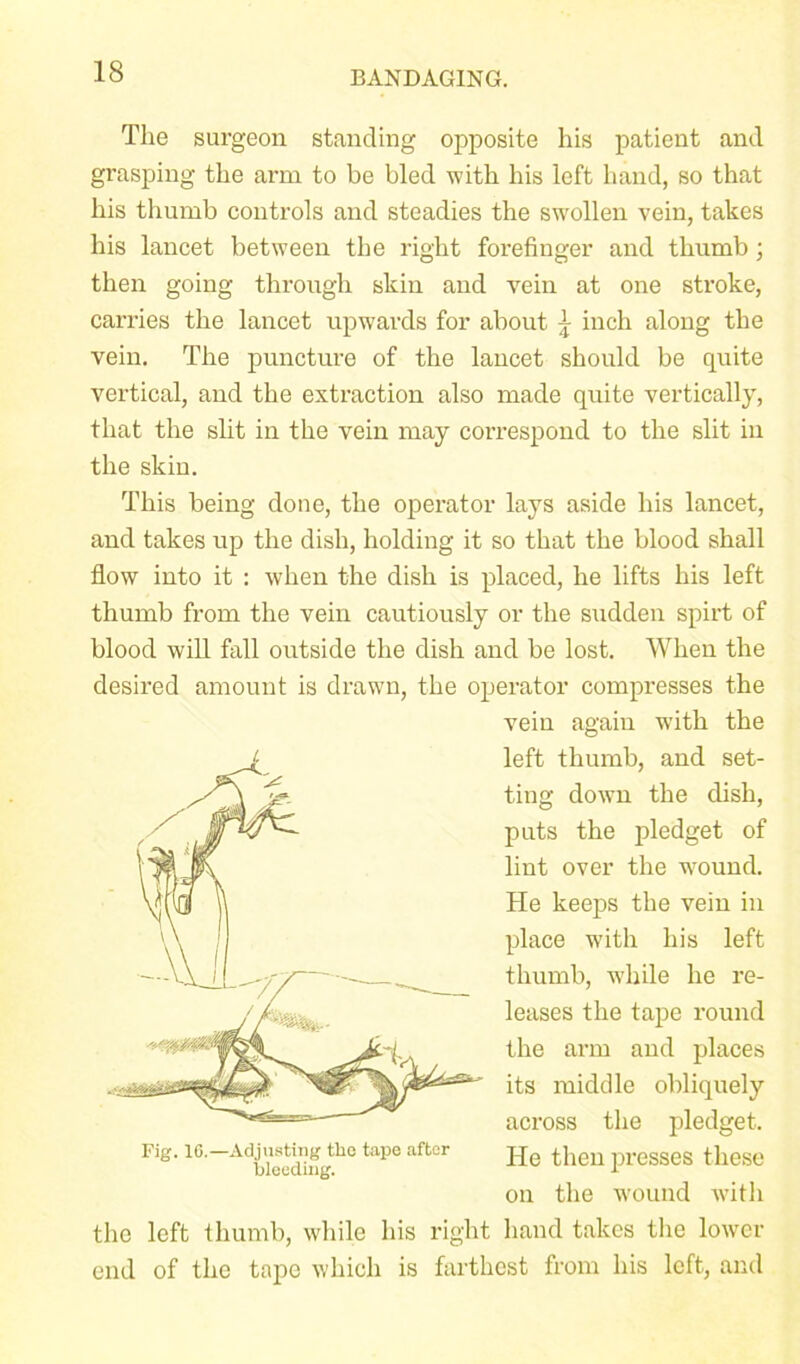 The surgeon standing opposite his patient and grasping the arm to be bled with his loft hand, so that his thumb controls and steadies the swollen vein, takes his lancet between the right forefinger and thumb; then going through skin and vein at one stroke, carries the lancet upwards for about 1 inch along the vein. The puncture of the lancet should be quite vertical, and the extraction also made quite vertically, that the slit in the vein may correspond to the slit in the skin. This being done, the operator lays aside his lancet, and takes up the dish, holding it so that the blood shall flow into it : when the dish is placed, he lifts his left thumb from the vein cautiously or the sudden spirt of blood will fall outside the dish and be lost. When the desired amount is drawn, the operator compresses the vein again with the left thumb, and set- ting down the dish, puts the pledget of lint over the wound. He keeps the vein in place with his left thumb, w'hile he re- leases the tape round the arm and places its middle obliquely across the pledget. He then presses these on the W'ound with the left thumb, while his right hand takes the lower end of the tape which is farthest from his left, and Fig. 16.—Adjusting tlie tape after bleeding.