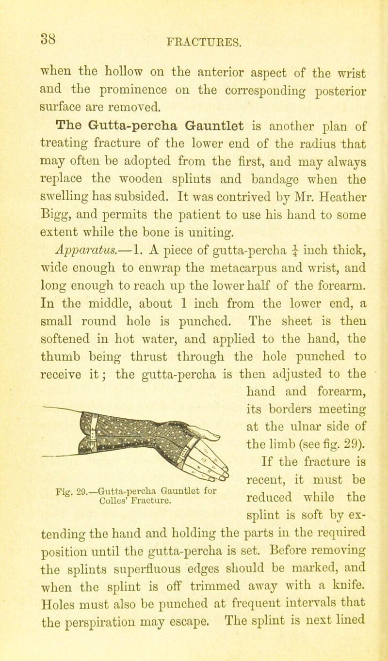 when the hollow on the anterior aspect of the wrist and the prominence on the corresponding posterior surface are removed. The Gutta-percha Gauntlet is another plan of treating fracture of the lower end of the radius that may often be adopted from the first, and may always replace the wooden splints and bandage when the swelling has subsided. It was contrived by Mr. Heather Bigg, and permits the patient to use his hand to some extent while the bone is uniting. Apparatus.—1. A piece of gutta-percha J inch thick, wide enough to enwrap the metacarpus and wrist, and long enough to reach up the lower half of the forearm. In the middle, about 1 inch from the lower end, a small round hole is punched. The sheet is then softened in hot water, and applied to the hand, the thumb being thrust through the hole punched to receive it; the gutta-percha is then adjusted to the tending the hand and holding the parts in the required position until the gutta-percha is set. Before removing the splints superfluous edges should be marked, and when the splint is off trimmed away with a knife. Holes must also be punched at frequent intervals that the perspiration may escape. The splint is next lined hand and forearm, its borders meeting at the ulnar side of the limb (see fig. 29). Fig. 29.—Gutta-percha Gauntlet for Colles’ Fracture. If the fracture is recent, it must be reduced while the splint is soft by ex-
