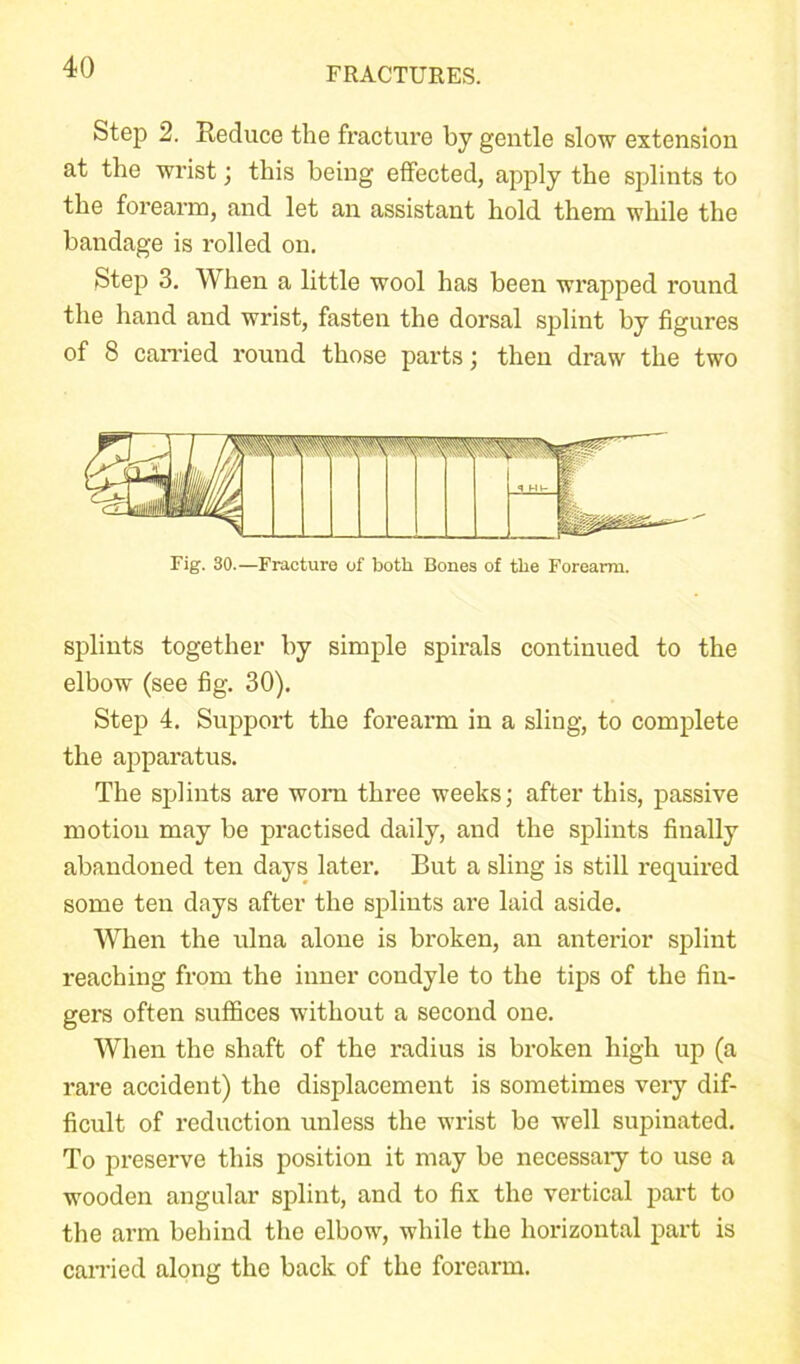 Step 2. Reduce the fracture by gentle slow extension at the wrist; this being effected, apply the splints to the forearm, and let an assistant hold them while the bandage is rolled on. Step 3. When a little wool has been wrapped round the hand and wrist, fasten the dorsal splint by figures of 8 earned round those parts; then draw the two Fig. 30.—Fracture of both Bones of the Forearm. splints together by simple spirals continued to the elbow (see fig. 30). Step 4. Support the forearm in a sling, to complete the apparatus. The splints are worn three weeks; after this, passive motion may be practised daily, and the splints finally abandoned ten days later. But a sling is still required some ten days after the splints are laid aside. When the ulna alone is broken, an anterior splint reaching from the inner condyle to the tips of the fin- gers often suffices without a second one. When the shaft of the radius is broken high up (a rare accident) the displacement is sometimes very dif- ficult of reduction unless the wrist be well supinated. To preserve this position it may be necessary to use a wooden angular splint, and to fix the vertical part to the arm behind the elbow, while the horizontal part is earned along the back of the forearm.