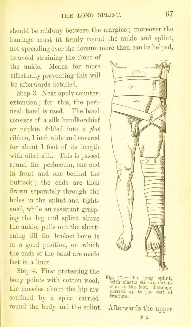 THE LONG SPLINT. should be midway between the margins; moreover the bandage must fit firmly round the ankle and splint, not spreading over the dorsum more than can be helped, to avoid straining the front of the ankle. Means for more effectually preventing this will be afterwards detailed. Step 3. Next apply counter- extension ; for this, the peri- neal band is used. The band consists of a silk handkerchief or napkin folded into a flat ribbon, 1 inch wide and covered for about 1 foot of its length with oiled silk. This is passed round the perinseum, one end in front and one behind the buttock ; the ends are then drawn separately through the holes in the splint and tight- ened, while an assistant grasp- ing the leg and splint above the ankle, pulls out the short- ening till the broken bone is in a good position, on which the ends of the band are made fast in a knot. Step 4. First protecting the bony points with cotton wool, the muscles about the hip are confined by a spica carried Fig.. 47.—The long splint, with elastic stirrup exten- sion at the foot. Bandage carried up to the seat of fracture. round the body and the splint. Afterwards the upper