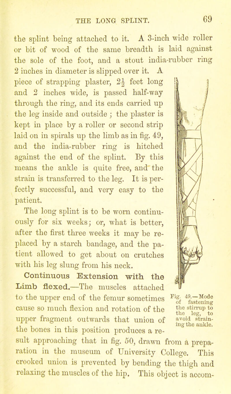 the splint being attached to it. A 3-inch wide roller or bit of wood of the same breadth is laid against the sole of the foot, and a stout india-rubber ring 2 inches in diameter is slipped over it. A piece of strapping plaster, 2\ feet long and 2 inches wide, is passed half-way through the ring, and its ends carried up the leg inside and outside ; the plaster is kept in place by a roller or second strip laid on in spirals up the limb as in fig. 49, and the india-rubber ring is hitched against the end of the splint. By this means the ankle is quite free, and the strain is transferred to the leg. It is per- fectly successful, and very easy to the patient. The long splint is to be worn continu- ously for six weeks; or, what is better, after the first three weeks it may be re- placed by a starch bandage, and the pa- tient allowed to get about on crutches with his leg slung from his neck. Continuous Extension with, the Limb flexed.—The muscles attached to the upper end of the femur sometimes cause so much flexion and rotation of the upper fragment outwards that union of the bones in this position produces a re- Fig. 49.—Mode of fastening the stirrup to the leg, to avoid strain- ing the ankle. suit approaching that in fig. 50, drawn from a prepa- ration in the museum of University College. This crooked union is prevented by bending the thigh and relaxing the muscles of the hip. This object is accom-