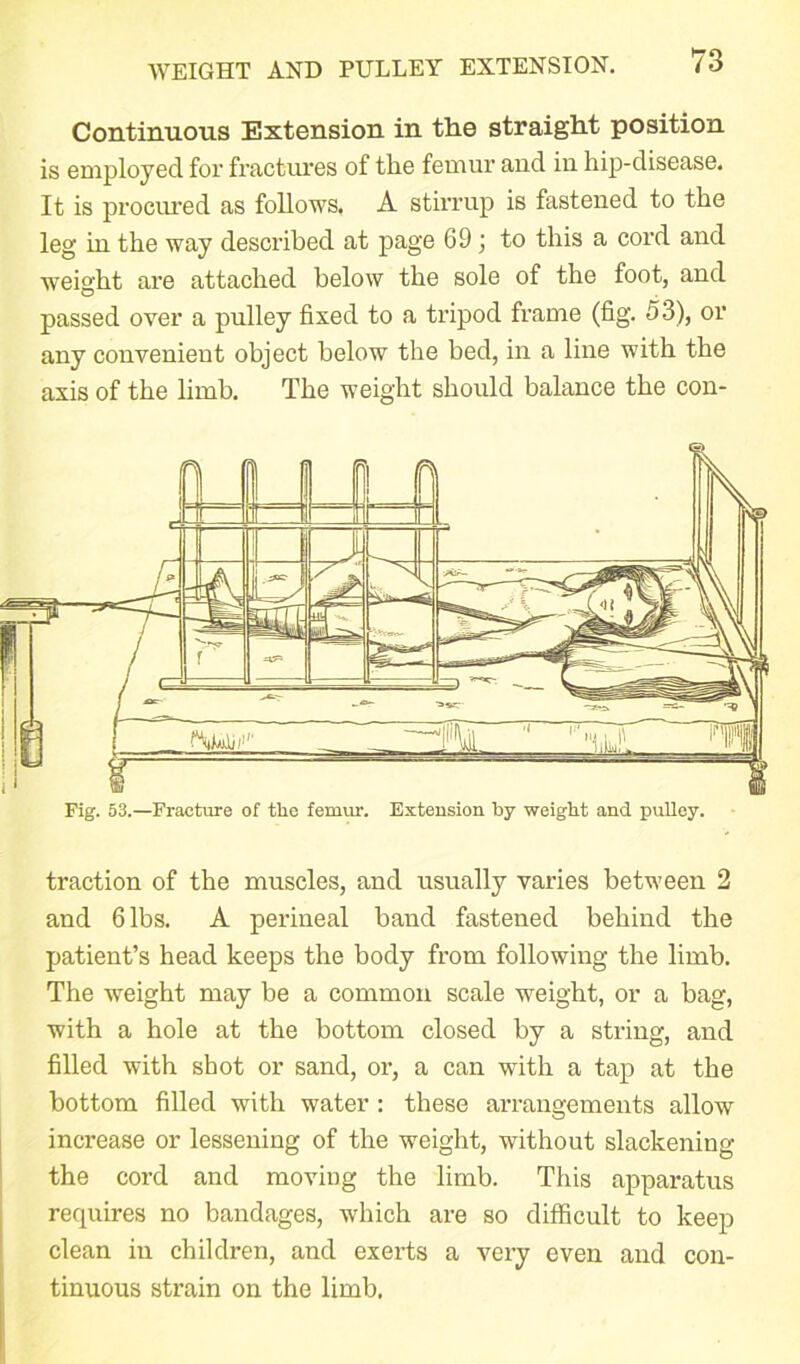 Continuous Extension in the straight position is employed for fractures of the femur and in hip-disease. It is procured as follows. A stirrup is fastened to the leg in the way described at page G9 j to this a cord and weight are attached below the sole of the foot, and passed over a pulley fixed to a tripod frame (fig. 53), or any convenient object below the bed, in a line with the axis of the limb. The weight should balance the con- Fig. 53.—Fracture of the femur. Extension by weight and pulley. traction of the muscles, and usually varies between 2 and 6 lbs. A perineal band fastened behind the patient’s head keeps the body from following the limb. The weight may be a common scale weight, or a hag, with a hole at the bottom closed by a string, and filled with shot or sand, or, a can with a tap at the bottom filled with water: these arrangements allow increase or lessening of the weight, without slackening the cord and moving the limb. This apparatus requires no bandages, which are so difficult to keep clean in children, and exerts a very even and con- tinuous strain on the limb.