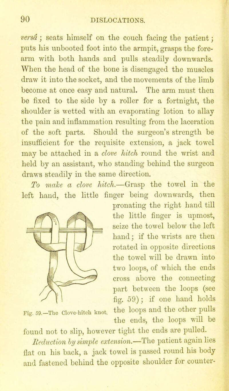 versa; seats himself on the couch facing the patient; puts his unbooted foot into the armpit, grasps the fore- arm with both hands and pulls steadily downwards. When the head of the bone is disengaged the muscles draw it into the socket, and the movements of the limb become at once easy and natural. The arm must then be fixed to the side by a roller for a fortnight, the shoulder is wetted with an evaporating lotion to allay the pain and inflammation resulting from the laceration of the soft parts. Should the surgeon’s strength be insufficient for the requisite extension, a jack towel may be attached in a clove hitch round the wrist and held by an assistant, who standing behind the surgeon draws steadily in the same direction. To make a clove hitch.—Grasp the towel in the left hand, the little finger being downwards, then pronating the right hand till the little finger is upmost, seize the towel below the left hand; if the wrists are then rotated in opposite directions the towel will be drawn into two loops, of which the ends cross above the connecting part between the loops (see fig. 59); if one hand holds Fig. 59.—The Clove-hitch knot, the loops and the other pulls the ends, the loops will be found not to slip, however tight the ends are pulled. Reduction by simple extension.—The patient again lies flat on his back, a jack towel is passed round his body and fastened behind the opposite shoulder for counter-