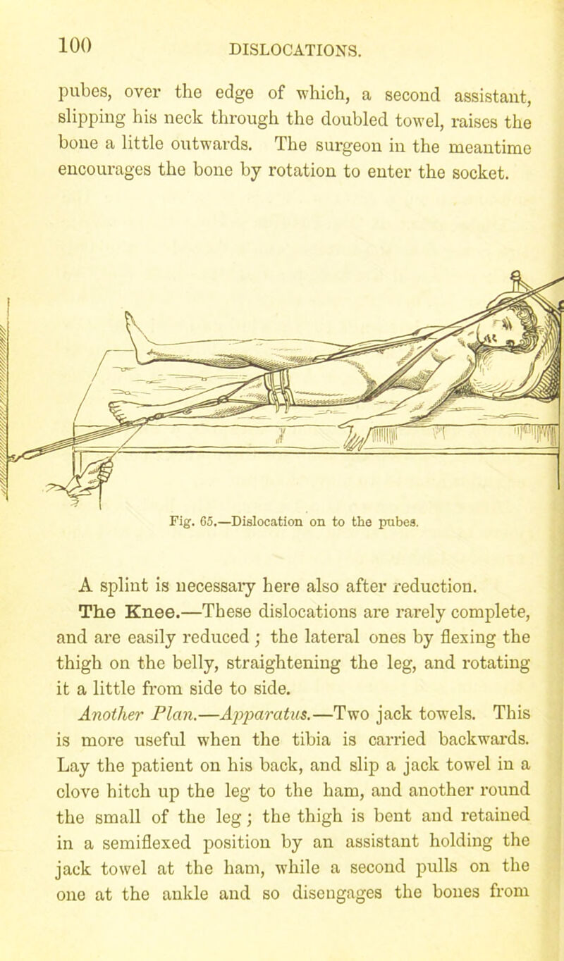 pubes, over the edge of which, a second assistant, slipping his neck through the doubled towel, raises the hone a little outwards. The surgeon in the meantime encourages the bone by rotation to enter the socket. A splint is necessary here also after reduction. The Knee.—These dislocations are rarely complete, and are easily reduced ; the lateral ones by flexing the thigh on the belly, straightening the leg, and rotating it a little from side to side. Another Plan.—Apparatus.—Two jack towels. This is more useful when the tibia is carried backwards. Lay the patient on his back, and slip a jack towel in a clove bitch up the leg to the ham, and another round the small of the leg; the thigh is bent and retained in a semiflexed position by an assistant holding the jack towel at the ham, while a second pulls on the one at the ankle and so disengages the bones from Fig. 65.—Dislocation on to the pubes.