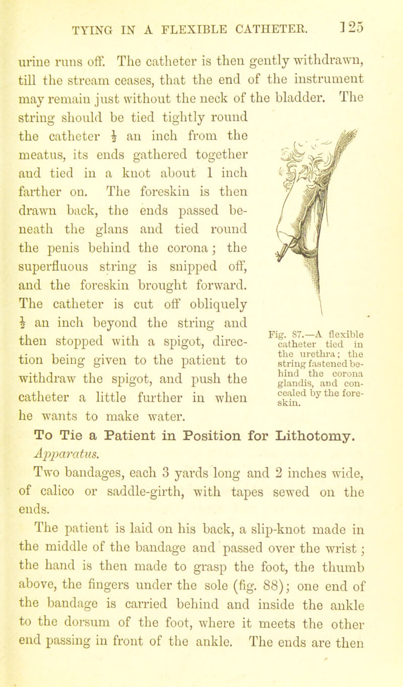 urine runs off. The catheter is then gently withdrawn, till the stream ceases, that the end of the instrument may remain just without the neck of the bladder. The string should be tied tightly round the catheter h an inch from the meatus, its ends gathered together aud tied in a knot about 1 inch farther on. The foreskin is then drawn back, the ends passed be- neath the glans and tied round the penis behind the corona; the superfluous string is snipped off, and the foreskin brought forward. The catheter is cut off obliquely i an inch beyond the string and then stopped with a spigot, direc- tion being given to the patient to withdraw the spigot, and push the catheter a little further in when he wants to make water. To Tie a Patient in Position for Lithotomy. Apparatus. Two bandages, each 3 yards long and 2 inches wide, of calico or saddle-girth, with tapes sewed on the ends. The patient is laid on his back, a slip-knot made in the middle of the bandage and passed over the wrist; the hand is then made to grasp the foot, the thumb above, the fingers under the sole (fig. 88); one end of the bandage is carried behind and inside the ankle to the dorsum of the foot, where it meets the other end passing in front of the ankle. The ends are then Fig. S7.—A flexible catheter tied in the urethra; the string fastened be- hind the corona glandis, and con- cealed by the fore- skin.