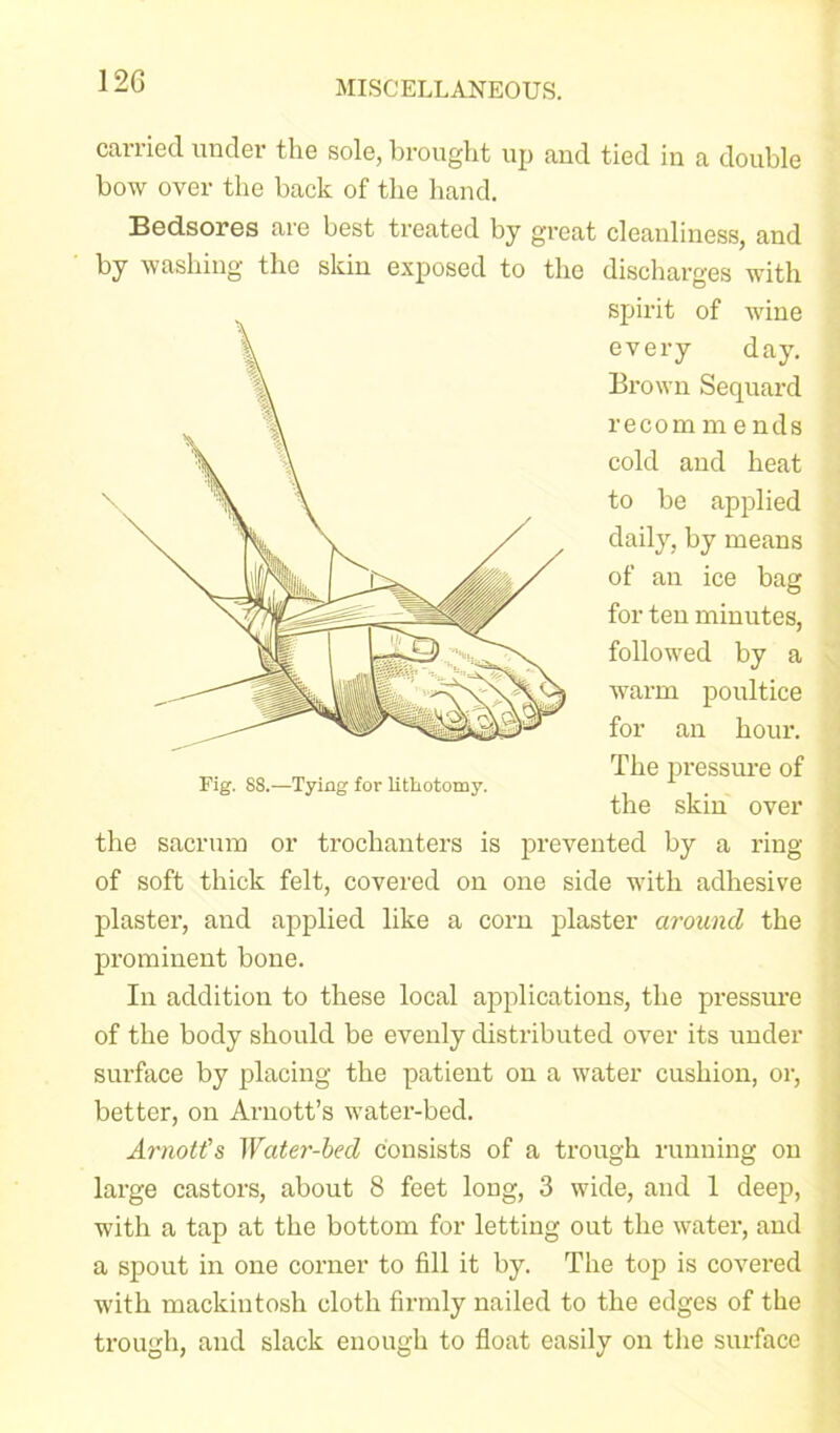 carried under the sole, brought up and tied in a double bow over the back of the hand. Bedsores are best treated by great cleanliness, and by washing the skin exposed to the discharges with the sacrum or trochanters is prevented by a ring of soft thick felt, covered on one side with adhesive plaster, and applied like a corn plaster around the prominent bone. In addition to these local applications, the pressure of the body should be evenly distributed over its under surface by placing the patient on a water cushion, or, better, on Arnott’s water-bed. Arnotfs Water-bed consists of a trough running on large castors, about 8 feet long, 3 wide, and 1 deep, with a tap at the bottom for letting out the water, and a spout in one corner to fill it by. The top is covered with mackintosh cloth firmly nailed to the edges of the trough, and slack enough to float easily on the surface \ Fig. 88.—Tying for lithotomy. spirit of wine every day. Brown Sequard recom m e nds cold and heat to be applied daily, by means of an ice bag for ten minutes, followed by a warm poultice for an hour. The pressure of the skin over