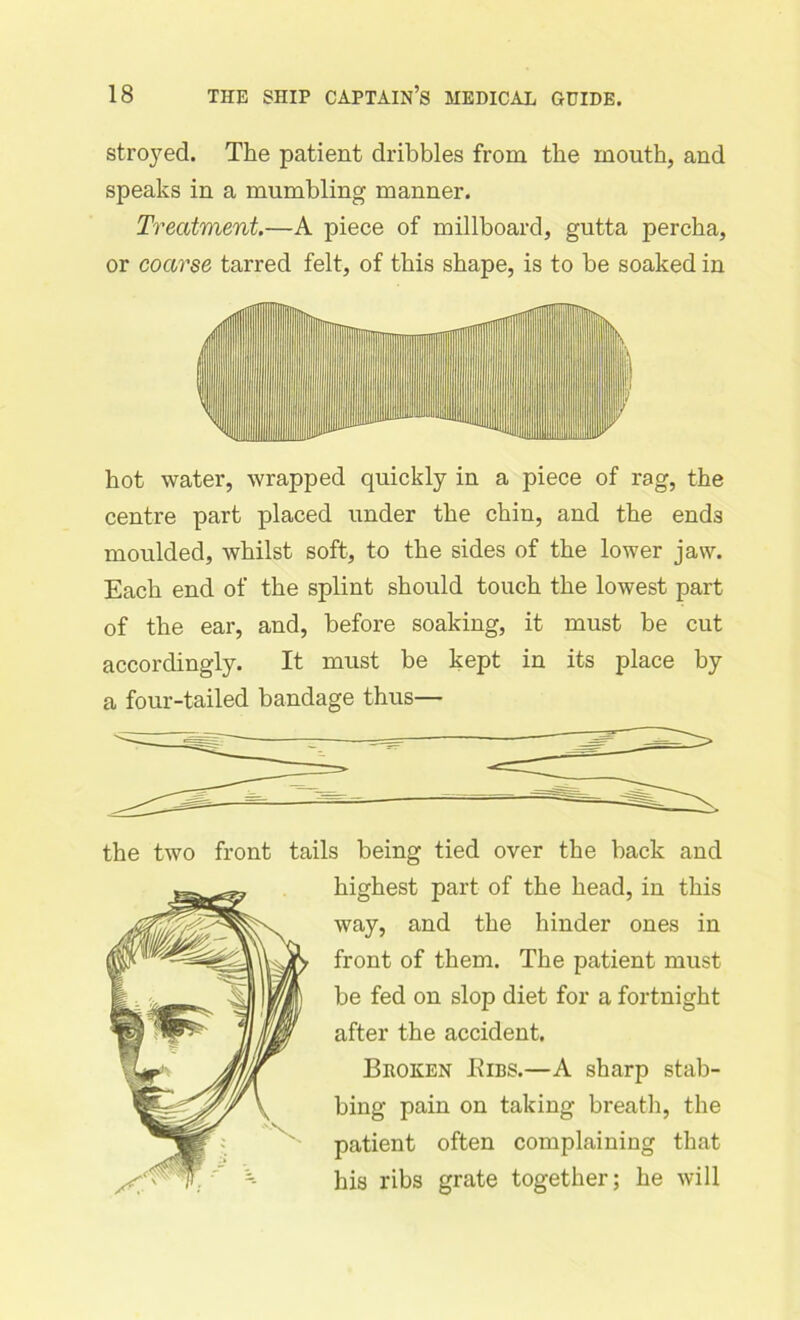 stroyed. The patient dribbles from the mouth, and speaks in a mumbling manner. Treatment.—A piece of millboard, gutta percha, or coarse tarred felt, of this shape, is to be soaked in hot water, wrapped quickly in a piece of rag, the centre part placed under the chin, and the ends moulded, whilst soft, to the sides of the lower jaw. Each end of the splint should touch the lowest part of the ear, and, before soaking, it must be cut accordingly. It must be kept in its place by a four-tailed bandage thus— the two front tails being tied over the back and highest part of the head, in this way, and the hinder ones in front of them. The patient must be fed on slop diet for a fortnight after the accident. Broken Bibs.—A sharp stab- bing pain on taking breath, the patient often complaining that his ribs grate together; he will