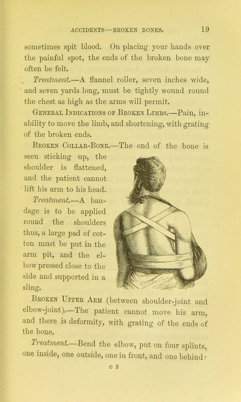 sometimes spit blood. On placing your hands over the painful spot, the ends of the broken bone may often be felt. Treatment.—A flannel roller, seven inches wide, and seven yards long, must be tightly wound round the chest as high as the arms will permit. General Indications of Broken Limbs.—Pain, in- ability to move the limb, and shortening, with grating of the broken ends. Broken Collar-Bone.—The end of the bone is seen sticking up, the shoulder is flattened, and the patient cannot lift his arm to his head. Treatment.—A ban- dage is to be applied round the shoulders thus, a large pad of cot- ton must be put in the arm pit, and the el- bow pressed close to the side and supported in a sling. Broken Upper Arm (between shoulder-joint and elbow-joint). The patient cannot move his arm, and there is deformity, with grating of the ends of the bone. Treatment.—Bend the elbow, put on four splints, one inside, one outside, one in front, and one behind: