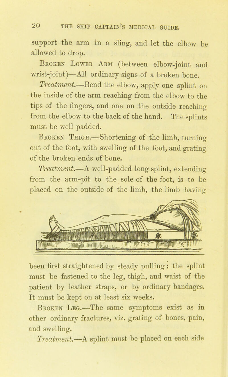 support the arm in a sling, and let the elbow be allowed to drop. Broken Lower Arm (between elbow-joint and wrist-joint)—All ordinary signs of a broken bone. Treatment.—Bend the elbow, apply one splint on the inside of the arm reaching from the elbow to the tips of the fingers, and one on the outside reaching from the elbow to the back of the hand. The splints must be well padded. Broken Thigh.—Shortening of the limb, turning out of the foot, with swelling of the foot, and grating of the broken ends of bone. Treatment.—A well-padded long splint, extending from the arm-pit to the sole of the foot, is to be placed on the outside of the limb, the limb having been first straightened by steady pulling ; the sjfiint must be fastened to the leg, thigh, and waist of the patient by leather straps, or by ordinary bandages. It must be kept on at least six weeks. Broken Leg.—The same symptoms exist as in other ordinary fractures, viz. grating of bones, pain, and swelling. Treatment.—A splint must be placed on each side
