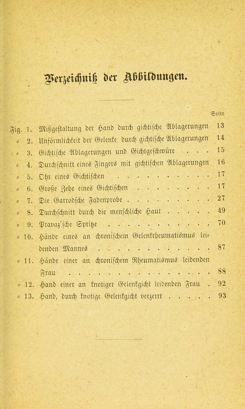 UH'qeidimf; bet jrOfitCbratgro. (Seite gig. l. SDUfjgeftaltung ber £anb burd) gid)tifd)e Ablagerungen 13 5 2. Unförmlidrteit ber ©elenfe buvd) gic^tifdje Ablagerungen 14 * 3. ©id)ti[d)e Ablagerungen unb ©id)tgefd)ttnire ... 15 * 4. S)urdifd)nitt cineö ginger« mit gid)tifd)cn Ablagerungen 16 * 5. Df>r eines ®id)tifd)en 17 s 6. ©roßc ßel;e eines ©idjtifdjen 17 ^ 7. üDie ©artobfdje gabenprobe 27 5 8. 2)urd)fd)nitt burd) bie menfd)lid)e paut 49 ^ 9; «Praoaj’fdje «Sprite 70 = 10. f>änbc eines an dn-onifd)em ©elcnErbeumatiSmuS lei* benben ÜJianneS 87 *11. #änbe einer an d)toni[d)em AljeumatiSmuS leibenben grau 88 * 12. £anb einer an {nötiger ®elcnt'gid)t leibenben grau . 92 * 13. $anb, burd) {nötige ©elenfgid)t oerjerrt 93