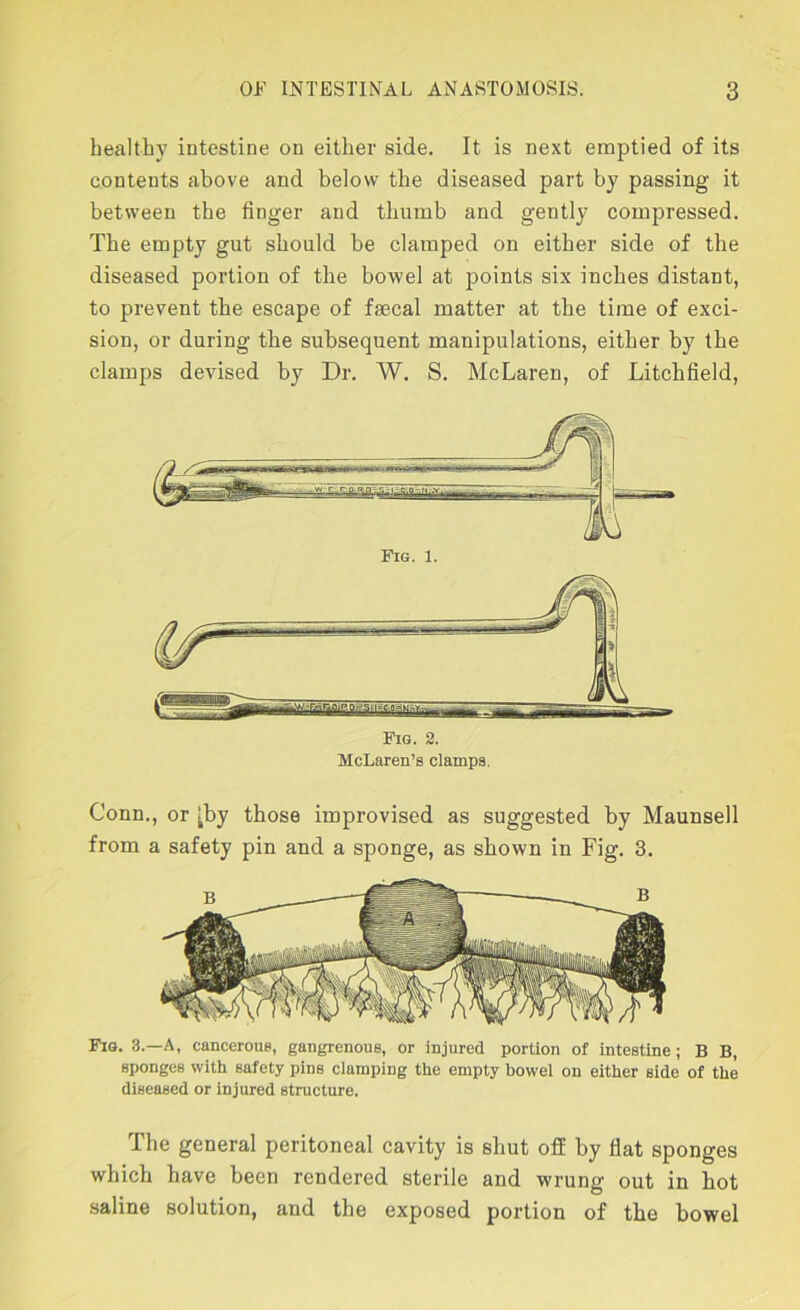 healtby intestine on either side. It is next emptied of its contents above and below the diseased part by passing it between the finger and thumb and gently compressed. The empty gut should be clamped on either side of the diseased portion of the bowel at points six inches distant, to prevent the escape of faecal matter at the time of exci- sion, or during the subsequent manipulations, either by the clamps devised by Dr. W. S. McLaren, of Litchfield, Fig. 2. McLaren’s clampa, Conn., or ^by those improvised as suggested by Maunsell from a safety pin and a sponge, as shown in Fig. 3. Fig. 3.—a, canceroua, gangrenous, or injured portion of intestine; B B, sponges with safety pins clamping the empty bowel on either side of the diseased or injured structure. The general peritoneal cavity is shut off by flat sponges which have been rendered sterile and wrung out in bot saline solution, and the exposed portion of the bowel