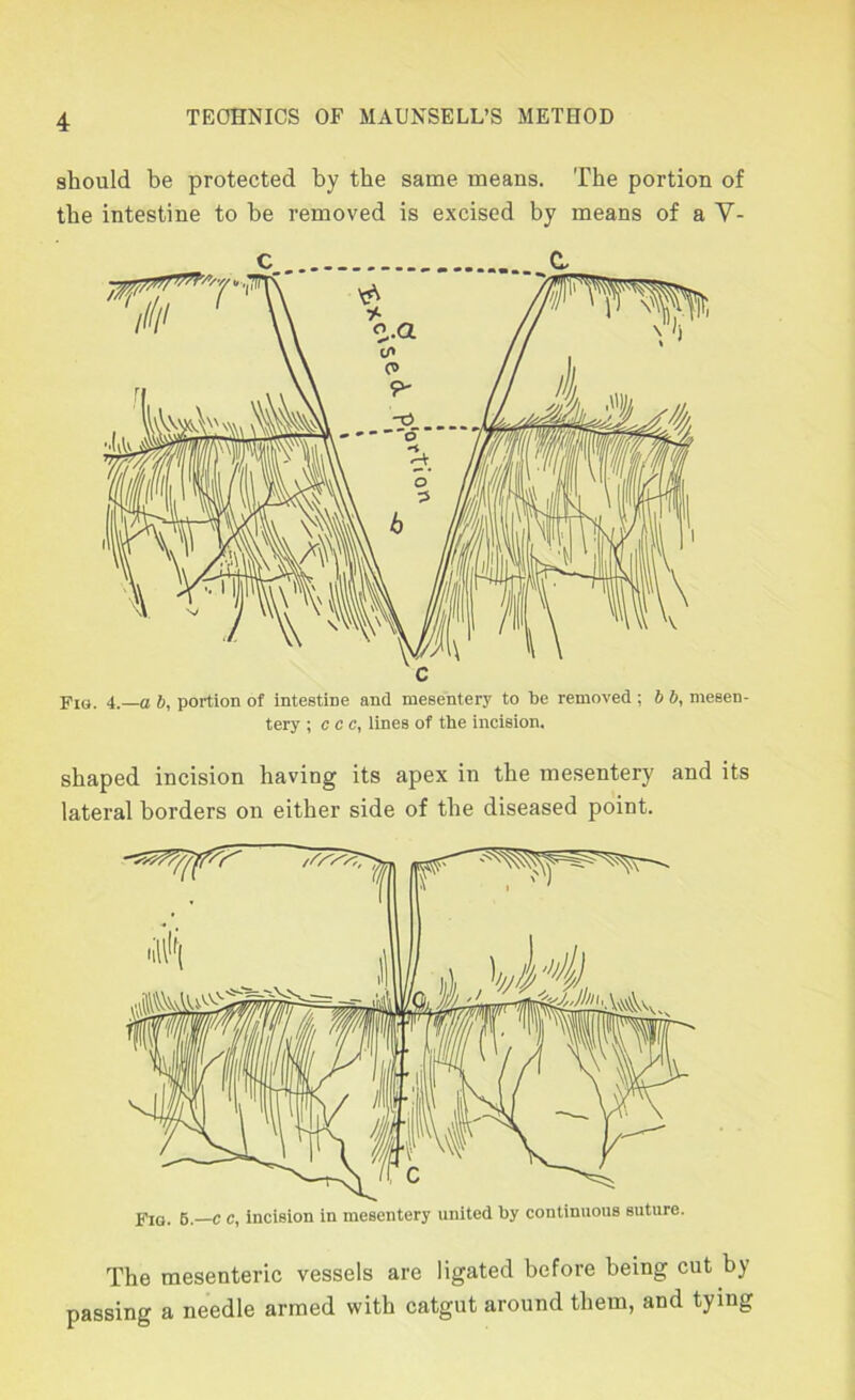 should be protected by the same means. The portion of the intestine to be removed is excised by means of a V- C C- PiQ. 4.—a b, portion of intestine and mesentery to be removed ; b b, mesen- tery ; c c c, lines of the incision. shaped incision having its apex in the mesentery and its lateral borders on either side of the diseased point. PiQ. 6. c c, incision in mesentery united by continuous suture. The mesenteric vessels are ligated before being cut by passing a needle armed with catgut around them, and tying