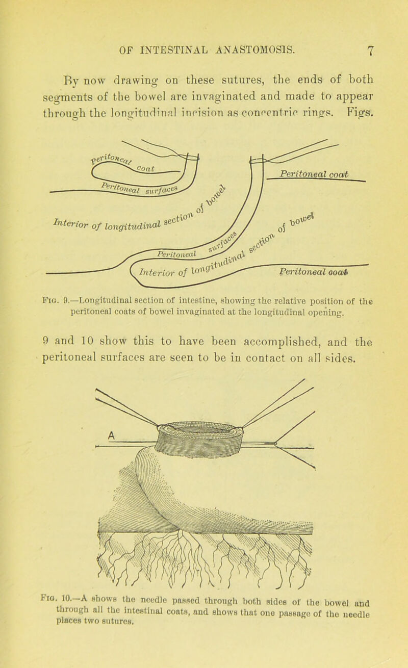 Bv now drawino- on these sutures, the ends of both seo-ments of the bowel are invaginated and made to appear through the longitudinal inrision as concentrio rings. F'igs. Fig. 9.—Longitudinal section of intestine, showing the relative position of the peritoneal coats of bowel invaginated at the longitudinal opening. 9 and 10 show this to have been accomplished, and the peritoneal surfaces are seen to be in contact on all sides. Fig. 10.—a shows the needle passed through both sides of the bowel and through all the intestinal coats, and shows that one passage of the needle places two sutures.