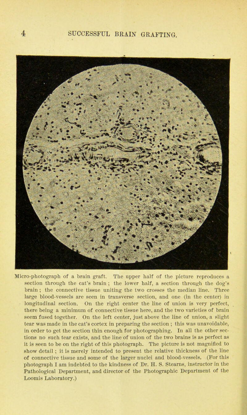 Micro-photograph of a brain graft. The upper half of the picture reproduces a section through the cat's brain ; the lower half, a section through the dog's brain ; the connective tissue uniting the two crosses the median line. Three large blood-vessels are seen in transverse section, and one (in the center) in longitudinal section. On the right center the line of union is very perfect, there being a minimum of connective tissue here, and the two varieties of brain seem fused together. On the left center, just above the line of union, a slight tear was made in the cat’s cortex in preparing the section ; this was unavoidable, in order to get the section thin enough for photographing. In all the other sec- tions no such tear exists, and the line of union of the two brains is as perfect as it is seen to be on the right of this photograph. The picture is not magnified to show detail ; it is merely intended to present the relative thickness of the line of connective tissue and some of the larger nuclei and blood-vessels. (For this photograph I am indebted to the kindness of Dr. H. S. Stearns, instructor in the Pathological Department, and director of the Photographic Department of the Loomis Laboratory.)