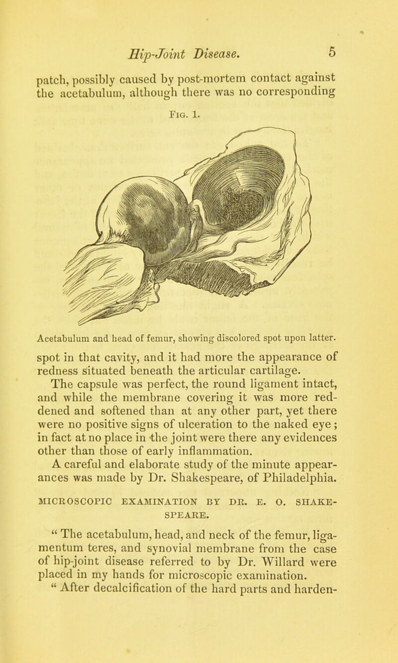 patch, possibly caused by post-mortem contact against the acetabulum, although there was no corresponding Fig. 1. Acetabulum and head of femur, showing discolored spot upon latter. spot in that cavity, and it had more the appearance of redness situated beneath the articular cartilage. The capsule was perfect, the round ligament intact, and while the membrane covering it was more red- dened and softened than at any other part, yet there were no positive signs of ulceration to the naked eye; in fact at no place in -the joint were there any evidences other than those of early inflammation. A careful and elaborate study of the minute appear- ances was made by Dr. Shakespeare, of Philadelphia. MICROSCOPIC EXAMINATION BY DR. E. O. SHAKE- SPEARE. “ The acetabulum, head, and neck of the femur, liga- mentum teres, and synovial membrane from the case of hip-joint disease referred to by Dr. Willard were placed in my hands for microscopic examination. “ After decalcification of the hard parts and harden-