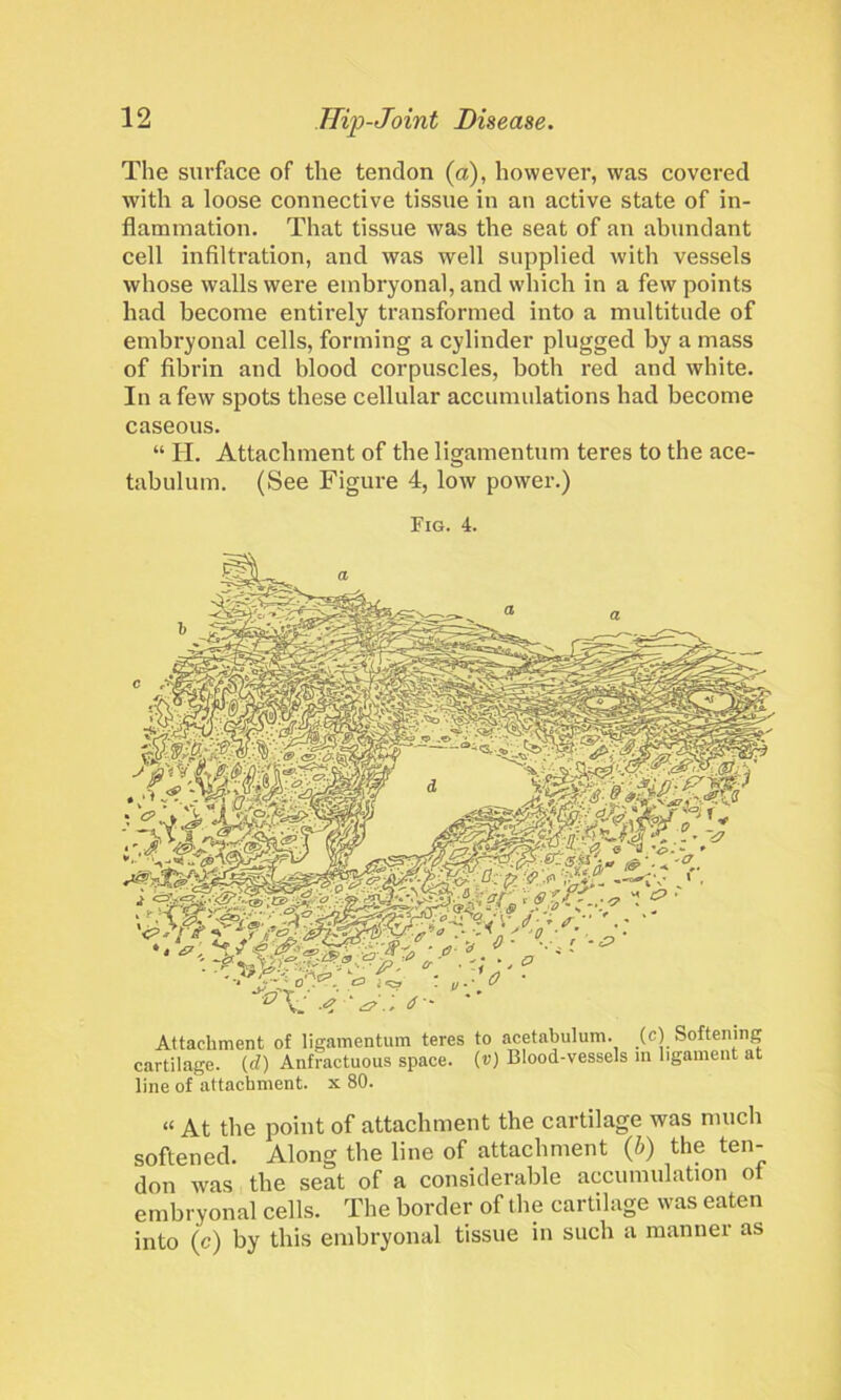 The surface of the tendon (a), however, was covered with a loose connective tissue in an active state of in- flammation. That tissue was the seat of an abundant cell infiltration, and was well supplied with vessels whose walls were embryonal, and which in a few points had become entirely transformed into a multitude of embryonal cells, forming a cylinder plugged by a mass of fibrin and blood corpuscles, both red and white. In a few spots these cellular accumulations had become caseous. “ H. Attachment of the ligamentum teres to the ace- tabulum. (See Figure 4, low power.) Fig. 4. Attachment of ligamentum teres to acetabulum, (c) Softening cartilage. (d) Anfractuous space. (v) Blood-vessels in ligament at line of attachment, x 80. « At the point of attachment the cartilage was much softened. Along the line of attachment (b) the ten- don was the seat of a considerable accumulation ot embryonal cells. The border of the cartilage was eaten into (c) by this embryonal tissue in such a manner as