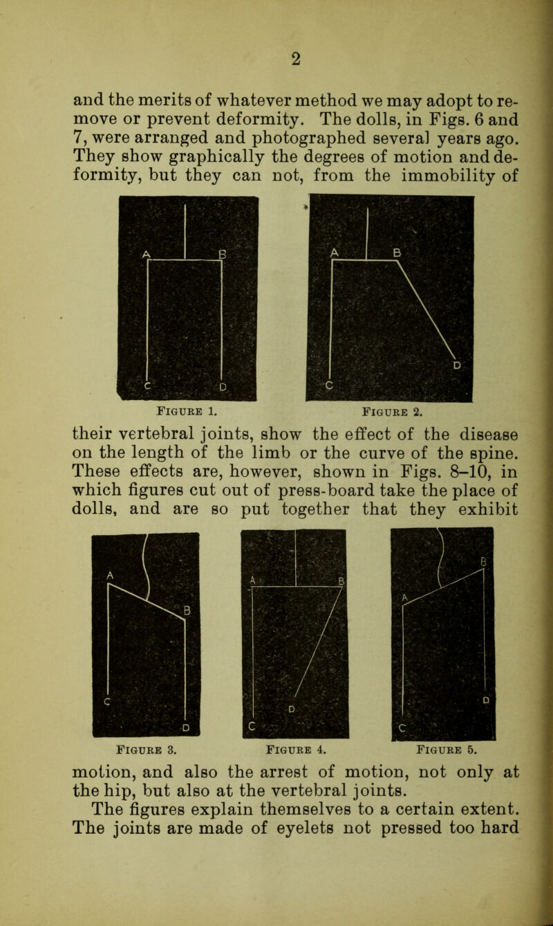 and the merits of whatever method we may adopt to re- move or prevent deformity. The dolls, in Figs. 6 and 7, were arranged and photographed several years ago. They show graphically the degrees of motion and de- formity, but they can not, from the immobility of their vertebral joints, show the effect of the disease on the length of the limb or the curve of the spine. These effects are, however, shown in Figs. 8-10, in which figures cut out of press-board take the place of dolls, and are so put together that they exhibit Figure 3. Figure 4. Figure 5. motion, and also the arrest of motion, not only at the hip, but also at the vertebral joints. The figures explain themselves to a certain extent. The joints are made of eyelets not pressed too hard