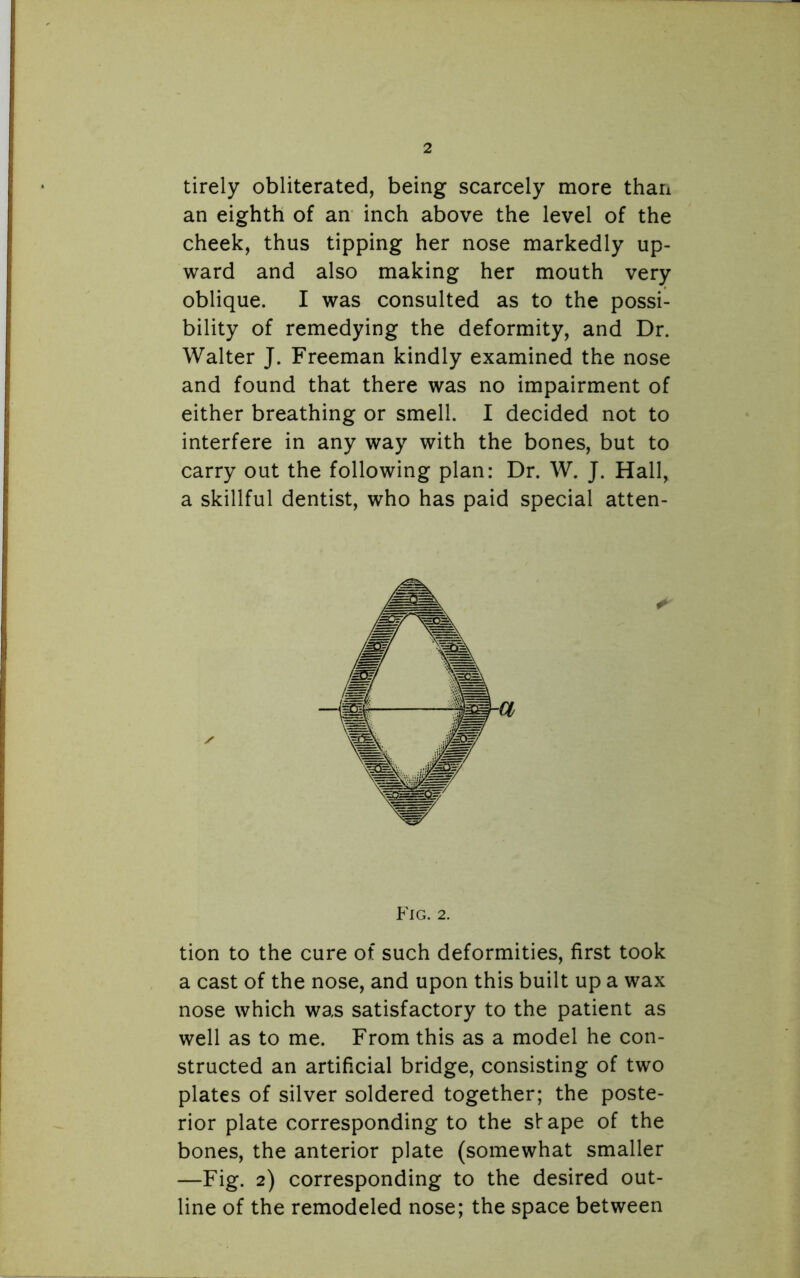 tirely obliterated, being scarcely more than an eighth of an inch above the level of the cheek, thus tipping her nose markedly up- ward and also making her mouth very oblique. I was consulted as to the possi- bility of remedying the deformity, and Dr. Walter J. Freeman kindly examined the nose and found that there was no impairment of either breathing or smell. I decided not to interfere in any way with the bones, but to carry out the following plan: Dr. W. J. Hall, a skillful dentist, who has paid special atten- tion to the cure of such deformities, first took a cast of the nose, and upon this built up a wax nose which was satisfactory to the patient as well as to me. From this as a model he con- structed an artificial bridge, consisting of two plates of silver soldered together; the poste- rior plate corresponding to the shape of the bones, the anterior plate (somewhat smaller —Fig. 2) corresponding to the desired out- line of the remodeled nose; the space between Fig. 2.