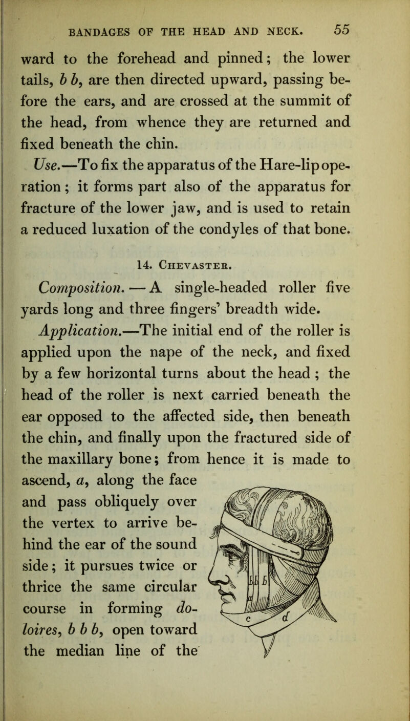 ward to the forehead and pinned; the lower tails, b 5, are then directed upward, passing be- fore the ears, and are crossed at the summit of the head, from whence they are returned and fixed beneath the chin. Use.—To fix the apparatus of the Hare-lip ope- ration ; it forms part also of the apparatus for fracture of the lower jaw, and is used to retain a reduced luxation of the condyles of that bone. 14. Chevaster. Composition. — A single-headed roller five yards long and three fingers’ breadth wide. Application.—The initial end of the roller is applied upon the nape of the neck, and fixed by a few horizontal turns about the head ; the head of the roller is next carried beneath the ear opposed to the affected side, then beneath the chin, and finally upon the fractured side of the maxillary bone; from hence it is made to ascend, a, along the face and pass obliquely over the vertex to arrive be- hind the ear of the sound side; it pursues twice or thrice the same circular course in forming do^ loires^ bbb^ open toward the median line of the