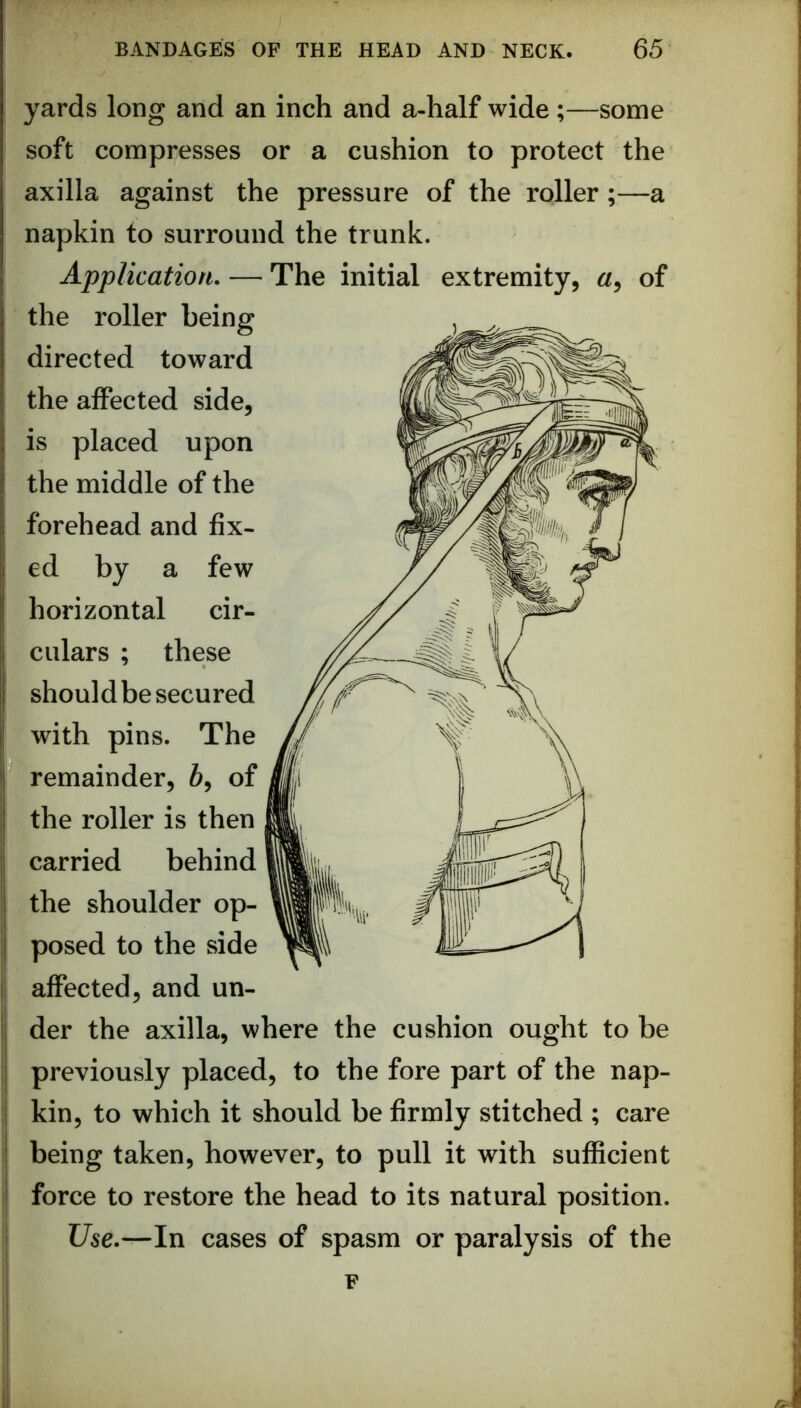 yards long and an inch and a-half wide ;—some soft compresses or a cushion to protect the axilla against the pressure of the roller;—a napkin to surround the trunk. Application. — The initial extremity, of the roller being directed toward the affected side, is placed upon the middle of the forehead and fix- ed by a few horizontal cir- culars ; these should be secured with pins. The remainder, 6, of the roller is then carried behind the shoulder op- posed to the side affected, and un- der the axilla, where the cushion ought to be previously placed, to the fore part of the nap- kin, to which it should be firmly stitched ; care being taken, however, to pull it with sufficient force to restore the head to its natural position. Use.—In cases of spasm or paralysis of the F