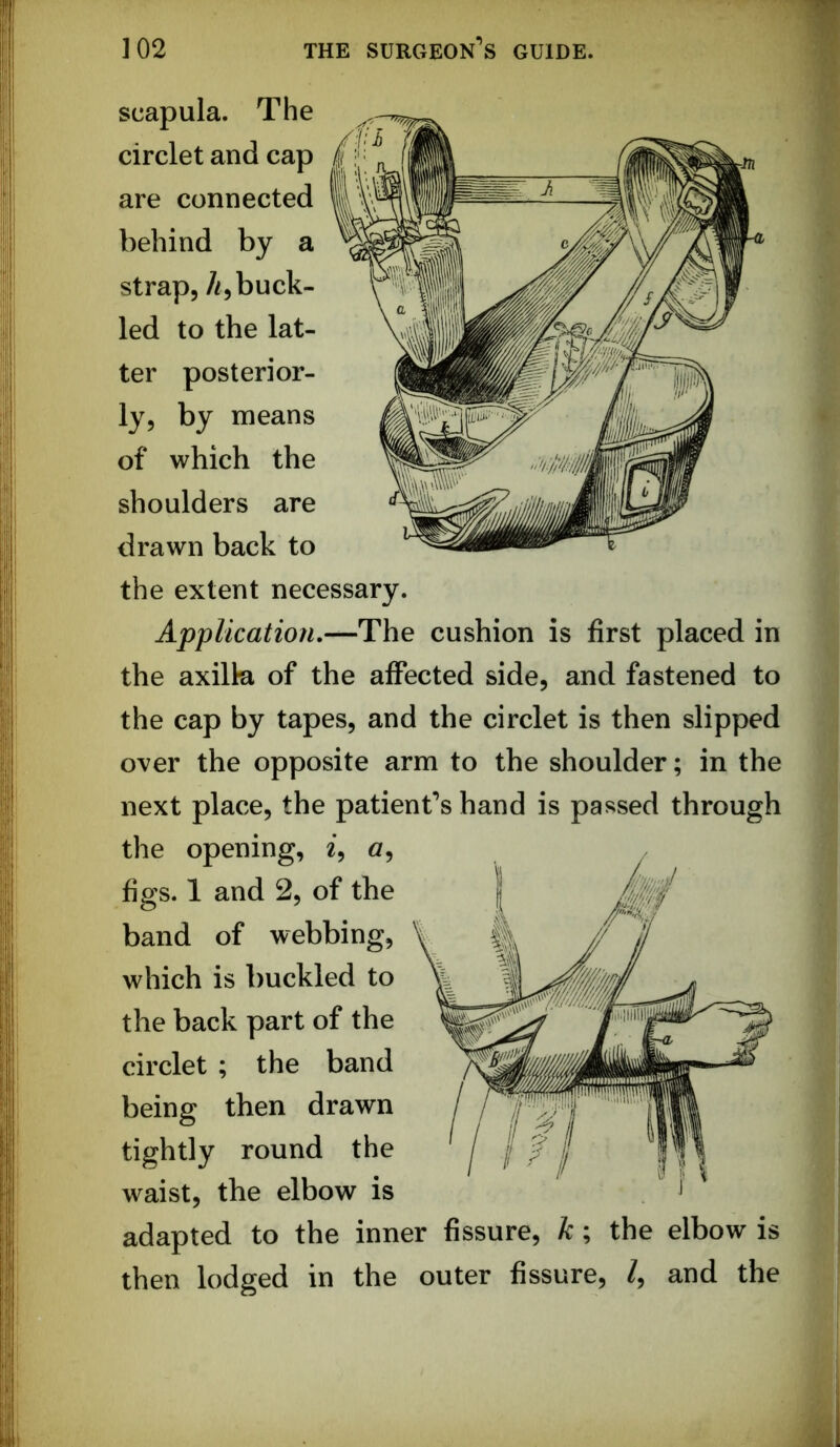 scapula. The circlet and cap are connected behind by a strap, /?,buck- led to the lat- ter posterior- ly, by means of which the shoulders are drawn back to the extent necessary. Application.—The cushion is first placed in the axilla of the affected side, and fastened to the cap by tapes, and the circlet is then slipped over the opposite arm to the shoulder; in the next place, the patient’s hand is passed through the opening, i, g, figs. 1 and 2, of the band of webbing, which is buckled to the back part of the circlet ; the band being then drawn tightly round the waist, the elbow is adapted to the inner fissure, k; the elbow is then lodged in the outer fissure, /, and the
