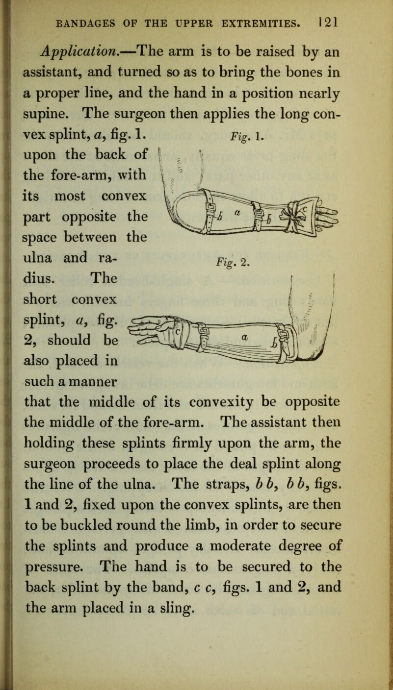 i “I I ! Application.—The arm is to be raised by an assistant, and turned so as to bring the bones in a proper line, and the hand in a position nearly supine. The surgeon then applies the long con- vex splint, a, fig. 1. Fig. I. upon the back of the fore-arm, with its most convex part opposite the space between the ulna and ra- dius. The short convex splint, fig. 2, should be also placed in such a manner that the middle of its convexity be opposite the middle of the fore-arm. The assistant then holding these splints firmly upon the arm, the surgeon proceeds to place the deal splint along the line of the ulna. The straps, 6 6, 6 6, figs. 1 and 2, fixed upon the convex splints, are then to be buckled round the limb, in order to secure the splints and produce a moderate degree of pressure. The hand is to be secured to the back splint by the band, c c, figs. 1 and 2, and the arm placed in a sling.
