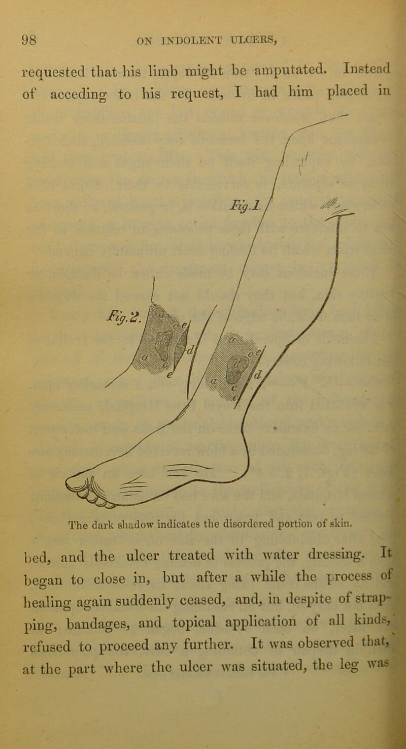 requested that his limb might be amputated. Instead of acceding to his request, I had him placed in The dark shadow indicates the disordered portion, of skin. bed, and the ulcer treated with water dressing. It beo-an to close in, but after a while the process of healing again suddenly ceased, and, in despite of strap- ping, bandages, and topical application of all kinds, refused to proceed any further. It was observed that, at the part where the ulcer was situated, the leg was