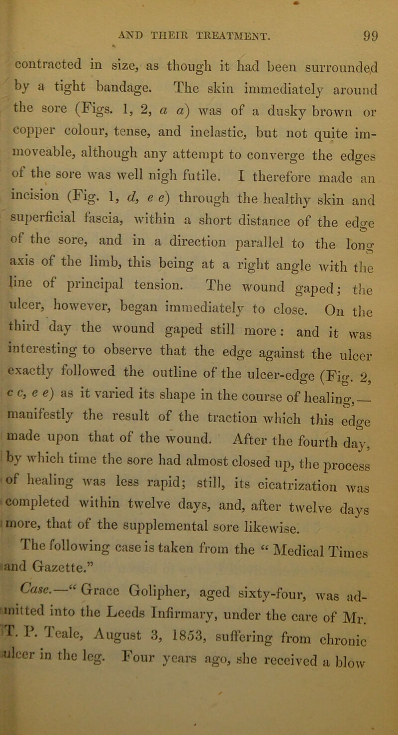 contracted in size, as though it had been surrounded by a tight bandage. The skin immediately around the sore (Figs. I, 2, a a) was of a dusky brown or copper colour, tense, and inelastic, but not quite im- moveable, although any attempt to converge the edges of the sore was well nigh futile. I therefore made an incision (Tig. 1, d, e e) through the healthy skin and superficial fascia, within a short distance of the edo-e ol the sore, and in a direction parallel to the long axis of the limb, this being at a right angle with the line of principal tension. The wound gaped; the ulcer, however, began immediately to close. On the third day the wound gaped still more : and it was interesting to observe that the edge against the ulcer exactly followed the outline of the ulcer-edge (Fig. 2, c c, e e) as it varied its shape in the course of healino- manifestly the result of the traction which this edge made upon that of the wound. After the fourth day. by which time the sore had almost closed up, the process of healing was less rapid; still, its cicatrization was completed within twelve days, and, after twelve days more, that of the supplemental sore likewise. The following case is taken from the “ Medical Times and Gazette.” Case. “ Grace Golipher, aged sixty-four, was ad- mitted into the Leeds Infirmary, under the care of Mr. 'T. P. leale, August 3, 1853, suffering from chronic wlcer m the leg. Four years ago, she received a blow