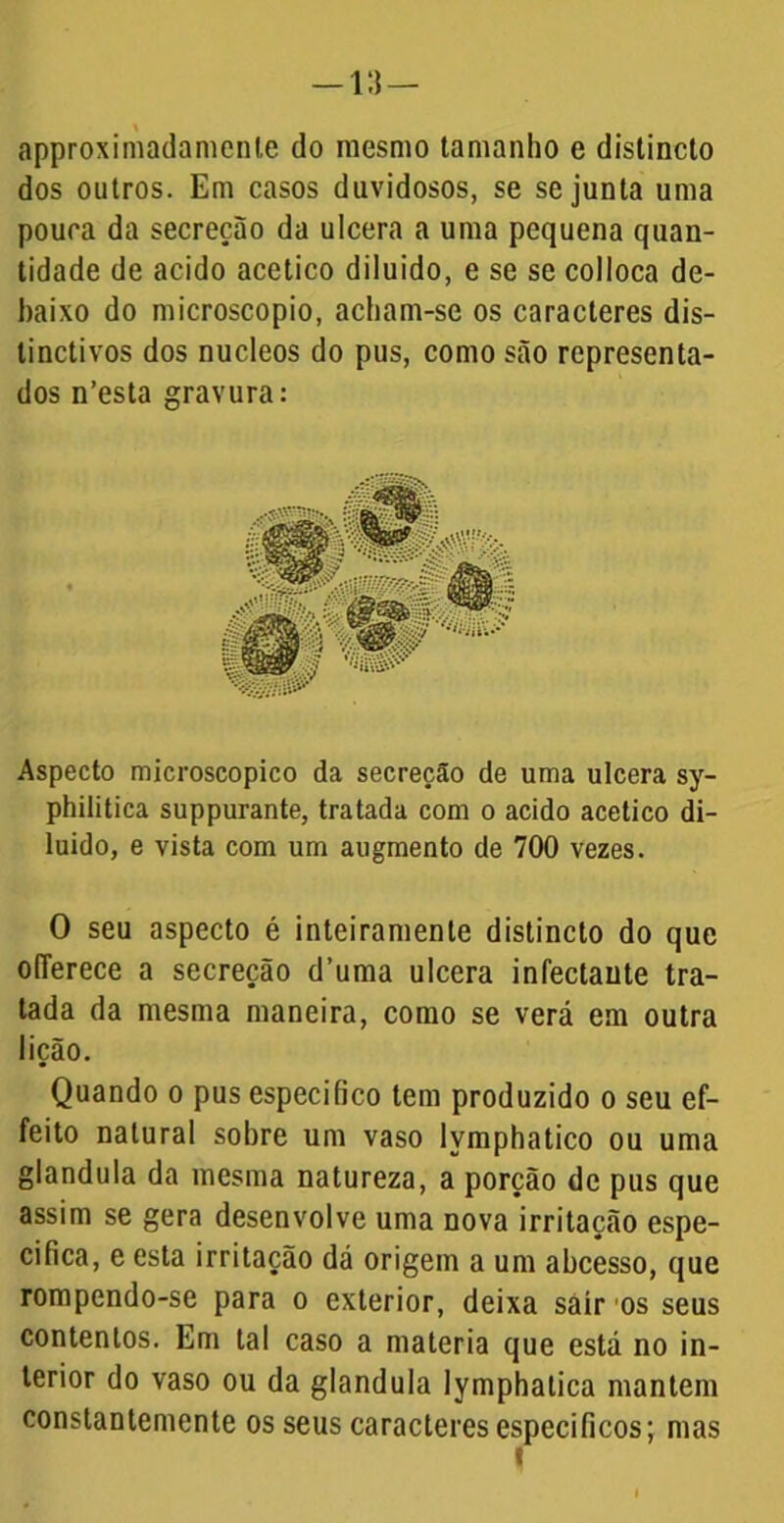 approximadamenle do mesmo tamanho e distincto dos outros. Em casos duvidosos, se se junta uma pouca da secreção da ulcera a uma pequena quan- tidade de acido acético diluido, e se se colloca de- baixo do microscopio, acham-se os caracteres dis- linctivos dos núcleos do pus, como são representa- dos n’esta gravura: Aspecto microscopico da secreção de uma ulcera sy- philitica suppurante, tratada com o acido acético di- luido, e vista com um augmento de 700 vezes. O seu aspecto é inteiramente distincto do que oITerece a secreção d’uma ulcera infectaute tra- tada da mesma maneira, como se verá em outra lição. Quando o pus especifico tem produzido o seu ef- feito natural sobre um vaso lymphatico ou uma glandula da mesma natureza, a porção de pus que assim se gera desenvolve uma nova irritação espe- cifica, e esta irritação dá origem a um abcesso, que rompendo-se para o exterior, deixa sair os seus contentos. Em tal caso a matéria que está no in- terior do vaso ou da glandula lymphalica mantem constantemente os seus caracteres específicos; mas