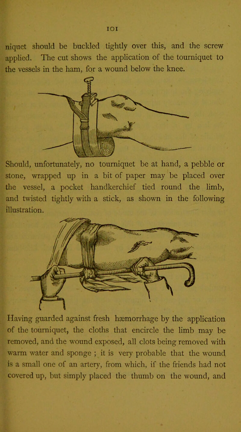 IOI niquet should be buckled tightly over this, and the screw applied. The cut shows the application of the tourniquet to the vessels in the ham, for a wound below the knee. Should, unfortunately, no tourniquet be at hand, a pebble or stone, wrapped up in a bit of paper may be placed over the vessel, a pocket handkerchief tied round the limb, and twisted tightly with a stick, as shown in the following illustration. Having guarded against fresh haemorrhage by the application of the tourniquet, the cloths that encircle the limb may be removed, and the wound exposed, all clots being removed with warm water and sponge ; it is very probable that the wound is a small one of an artery, from which, if the friends had not covered up, but simply placed the thumb on the wound, and