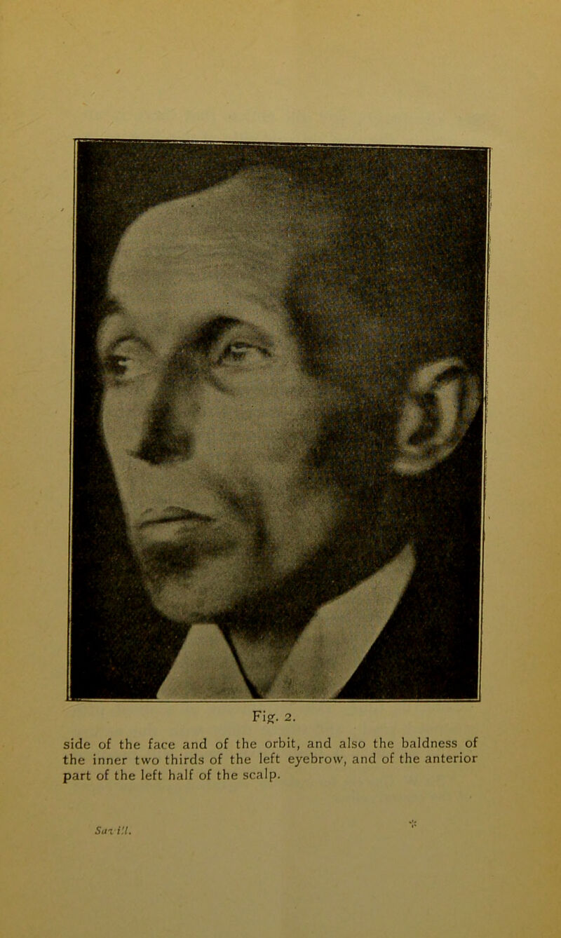 side of the face and of the orbit, and also the baldness of the inner two thirds of the left eyebrow, and of the anterior part of the left half of the scalp. Sazi'.l.