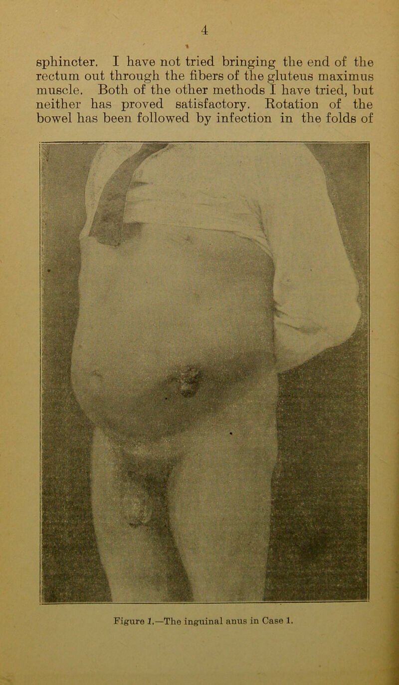 sphincter, I have not tried bringing the end of the rectum out through the fibers of the gluteus maximus muscle. Both of the other methods I have tried, but neither has proved satisfactory. Rotation of the bowel has been followed by infection in the folds of Figure 1.—The inguinal anus in Case 1