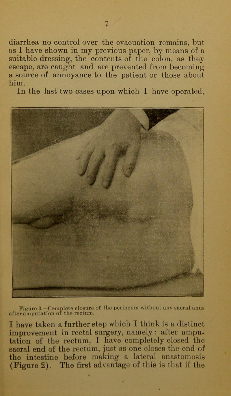 diarrhea no control over the evacuation remains, but as I have shown in my previous paper, by means of a suitable dressing, the contents of the colon, as they escape, are caught and are prevented from becoming a source of annoyance to the patient or those about him. In the last two cases upon which I have operated. Figure .3.—Complete closure of tlio perineum without any sacral anus after amputation of the rectum. I have taken a further step which I think is a distinct improvement in rectal surgery, namely: after ampu- tation of the rectum, I have completely closed the sacral end of the rectum, just as one closes the end of the intestine before making a lateral anastomosis (Figure 2). The first advantage of this is that if the