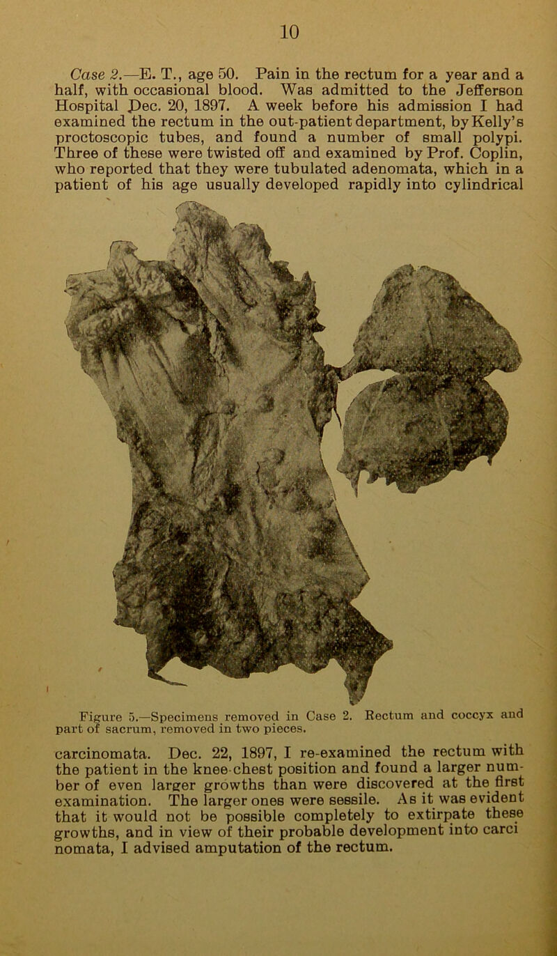 Case 2.—E. T., age 50. Pain in the rectum for a year and a half, with occasional blood. Was admitted to the Jefferson Hospital Pec. 20, 1897. A week before his admission I had examined the rectum in the out-patient department, by Kelly’s proctoscopic tubes, and found a number of small polypi. Three of these were twisted off and examined by Prof. Coplin, who reported that they were tubulated adenomata, which in a patient of his age usually developed rapidly into cylindrical I carcinomata. Dec. 22, 1897, I re-examined the rectum with the patient in the knee-chest position and found a larger num- ber of even larger growths than were discovered at the first examination. The larger ones were sessile. As it was evident that it would not be possible completely to extirpate these growths, and in view of their probable development into carci nomata, I advised amputation of the rectum. Figure 5.—Specimens removed in Case 2. Eectum and coccyx and part of sacrum, removed in two pieces.