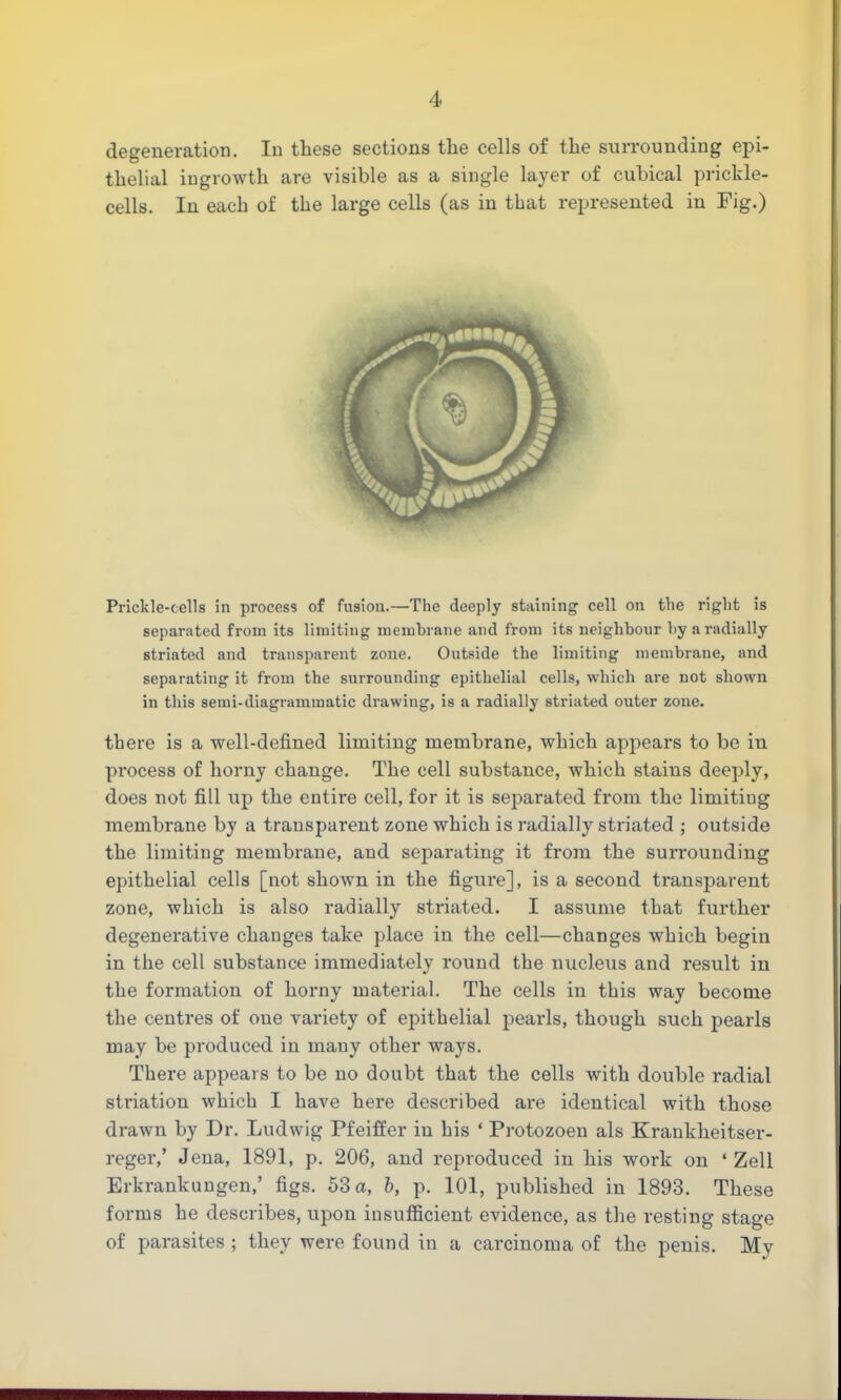 degeneration. In these sections the cells of the surrounding epi- thelial ingrowth are visible as a single layer of cubical prickle- cells. In each of the large cells (as in that represented in Fig.) Prickle-cells in process of fusion.—The deeply staining cell on the right is separated from its limiting membrane and from its neighbour by a radially striated and transparent zone. Outside the limiting membrane, and separating it from the surrounding epithelial cells, which are not shown in this semi-diagrammatic drawing, is a radially striated outer zone. there is a well-defined limiting membrane, which appears to be in process of horny change. The cell substance, which stains deeply, does not fill up the entire cell, for it is separated from the limitiug membrane by a transparent zone which is radially striated ; outside the limiting membrane, and separating it from the surrounding epithelial cells [not shown in the figure], is a second transparent zone, which is also radially striated. I assume that further degenerative changes take place in the cell—changes which begin in the cell substance immediately round the nucleus and result in the formation of horny material. The cells in this way become the centres of oue variety of epithelial pearls, though such pearls may be produced in many other ways. There appears to be no doubt that the cells with double radial striation which I have here described are identical with those drawn by Dr. Ludwig Pfeiffer in his ' Protozoen als Kraukheitser- reger,' Jena, 1891, p. 206, and reproduced in his work on * Zell Erkrankungen,' figs. 53 a, b, p. 101, published in 1893. These forms he describes, upon insufficient evidence, as the resting stage of parasites ; they were found in a carcinoma of the penis. My