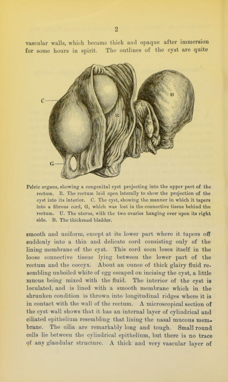 vascular walls, which became thick and opaque after immersion for some hours iu spirit. The outlines of the cyst are quite Pelvic organs, showing a congenital cyst projecting into the upper part of the rectum. R. The rectum laid open laterally to show the projection of the cyst into its interior. C. The cyst, showing the manner in which it tapers into a fibrous cord, G, which was lost in the connective tissue behind the rectum. U. The uterus, with the two ovaries hanging over upon its right side. B. The thickened bladder. smooth and uniform, except at its lower part where it tapers off suddenly into a thin and delicate cord consisting only of the lining membrane of the cyst. This cord soon loses itself in the loose connective tissue lying between the lower part of the rectum and the coccyx. About an ounce of thick glairy fluid re- sembling unboiled white of egg escaped on incising the cyst, a little mucus being mixed with the fluid. The interior of the cyst is loculated, and is lined with a smooth membi'ane which in the shrunken condition is thrown into longitudinal ridges where it is in contact Avith the wall of the rectum. A microscopical section of the cyst wall shows that it has an internal layer of cylindrical and ciliated epithelium resembling that lining the nasal mucous mem- brane. The cilia are remarkably long and tough. Small round cells lie between the cylindrical epithelium, but there is no trace of any glaudular structure. A thick and very vascular layer of