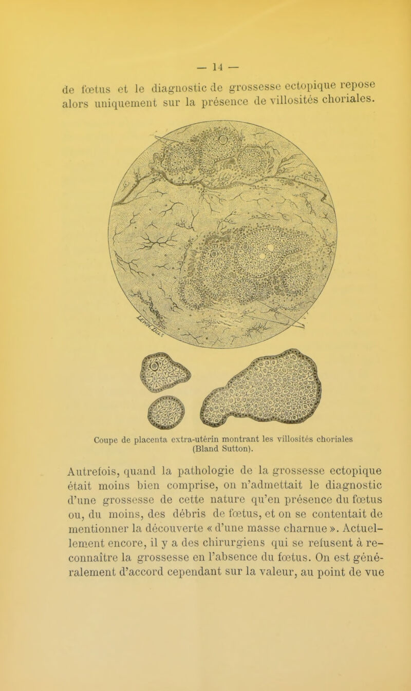 de fœtus et le diagnostic de grossesse ectopique repose alors uniquement sur la présence de villosités choriales. Coupe de placenta extra-utérin montrant les villosités choriales (Bland Sutton). Autrefois, quand la pathologie de la grossesse ectopique était moins bien comprise, on n'admettait le diagnostic d'une grossesse de cette nature qu'en présence du fœtus ou, du moins, des débris de fœtus, et on se contentait de mentionner la découverte « d'une masse charnue ». Actuel- lement encore, il y a des chirurgiens qui se refusent à re- connaître la grossesse en l'absence du fœtus. On est géné- ralement d'accord cependant sur la valeur, au point de vue