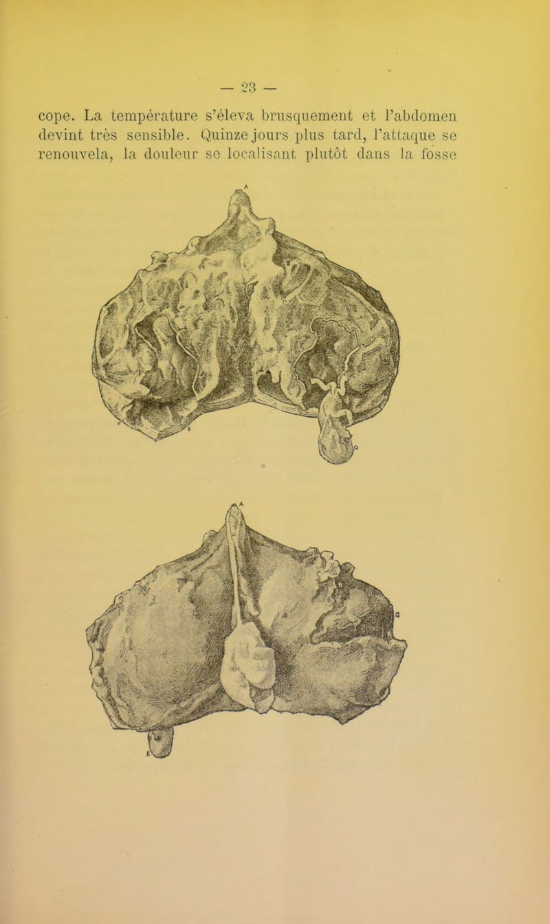 cope. La température s'éleva brusquement et l'abdomen devint très sensible. Quinze jours plus tard, l'attaque se renouvela, la douleur se localisant plutôt dans la fosse