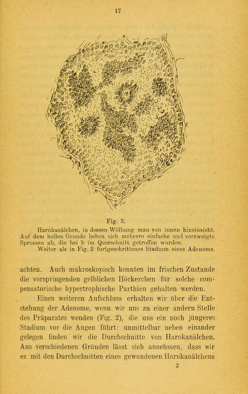 Fig. 3. Harnkanälchen, in dessen Wölbung man von innen hineinsieht. Auf dem hellen Grunde heben sich mehrere einfache und verzweigte Sprossen ab, die bei b im Querschnitt getroffen wurden. Weiter als in Fig. 2 fortgeschrittenes Stadium eines Adenoms. achten. Auch makroskopisch konnten im frischen Zustande, die vorspringenden gelblichen Höckerchen für solche com- pensatorische hypertrophische Parthien gehalten werden. Einen weiteren Aufschlnss erhalten wir über die Ent- stehung der Adenome, wenn wir uns zu einer andern Stelle des Präparates wenden (Fig. 2), die uns ein noch jüngeres Stadium vor die Augen führt: unmittelbar neben einander gelegen finden wir die Durchschnitte von Harnkanälchen. Aus verschiedenen Gründen lässt sich annehmen, dass wir es mit den Durchschnitten eines gewundenen Harnkanälchens 2