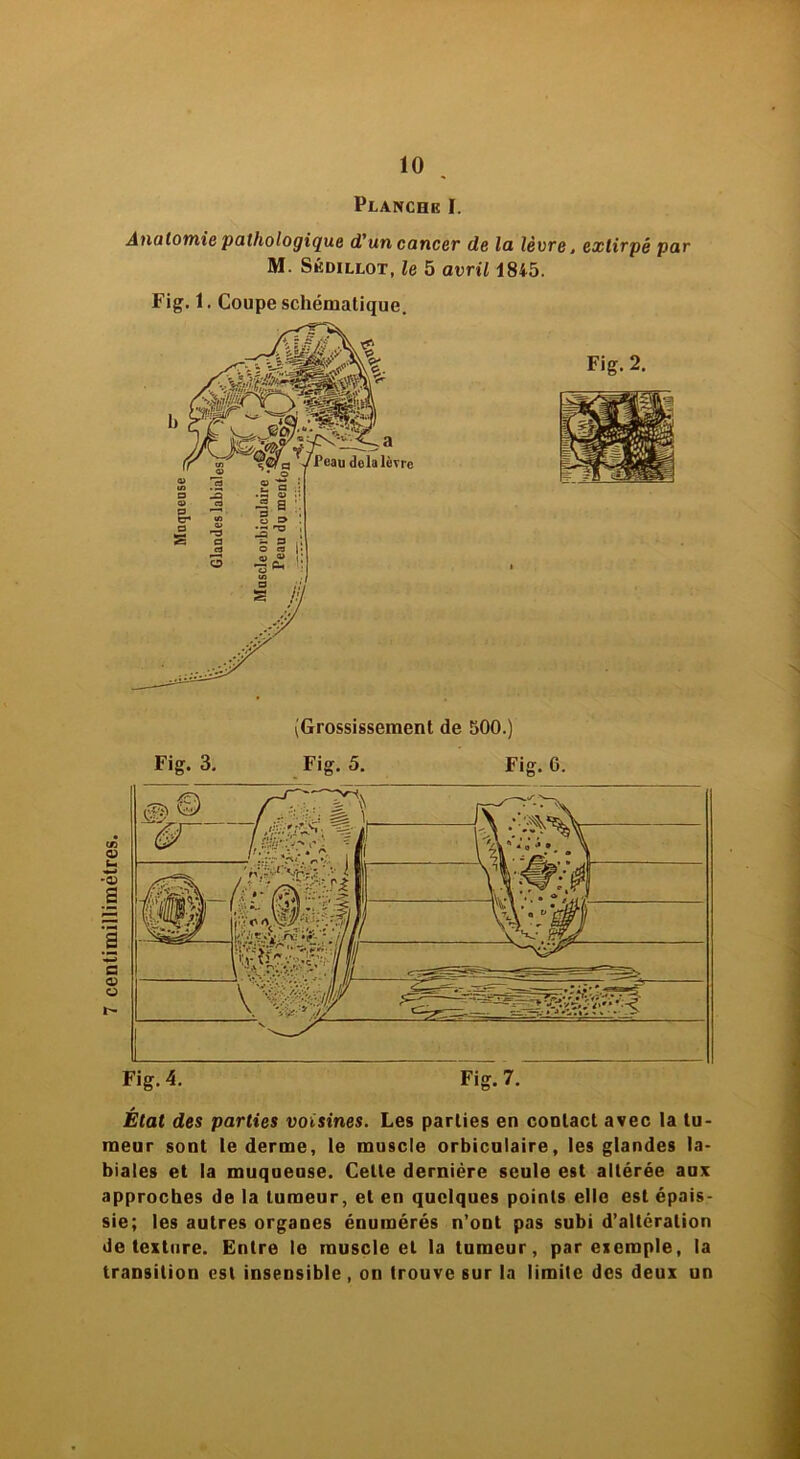 7 centimillimétres Planche I. Anatomie pathologique d'un cancer de la lèvre, extirpé par M. Sédillot, le 5 avril 1845. Fig. 1. Coupe schématique. (Grossissement de 500.) Fig. 2. Fig. 3. Fig. 5. Fig. 6. État des parties voisines. Les parties en contact avec la tu- meur sont le derme, le muscle orbiculaire, les glandes la- biales et la muqueuse. Celle dernière seule est altérée aux approches de la tumeur, et en quelques points elle est épais- sie; les autres organes énumérés n’ont pas subi d’altération de texture. Entre le muscle et la tumeur, par exemple, la transition est insensible, on trouve sur la limite des deux un