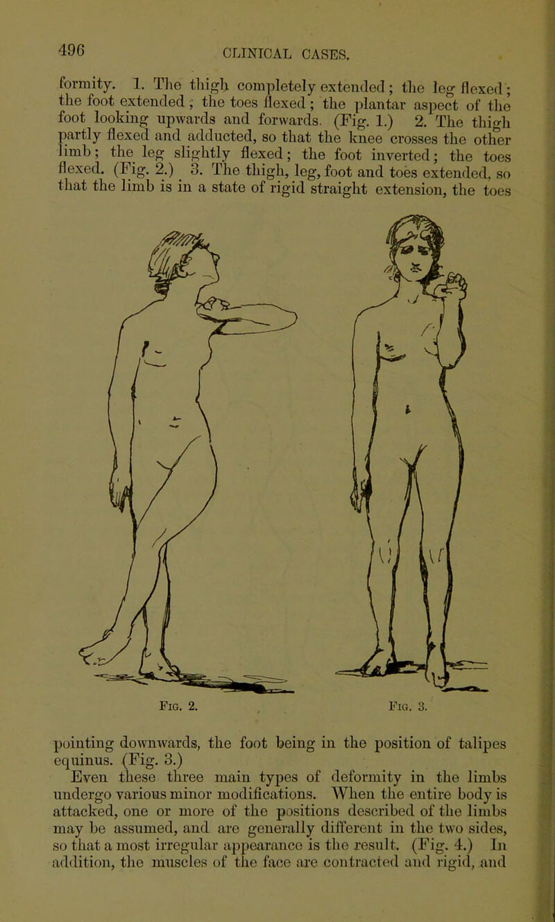 formity. 1. The tliif^h completely extended ; the log flexed; the foot extended ; the toes flexed ; the plantar aspect of the foot looking upwards and forwards. (Fig. 1.) 2. The thigh partly flexed and adducted, so that the knee crosses the other limb; the leg slightly flexed; the foot inverted; the toes flexed. (Fig. 2.) 3. The thigh, leg, foot and toes extended, so that the limb is in a state of rigid straight extension, the toes Fig. 2. Fig. 3. pointing downwards, the foot being in the position of talipes equinus. (Fig. 3.) Even these tliree main types of deformity in the limbs undergo various minor modifications. When the entire body is attacked, one or more of the positions described of the limbs may be assumed, and are generally different in the two sides, so that a most irregular appearance is the result. (Fig. 4.) In addition, tlie muscles of the face ai'e contracted and rigid, and