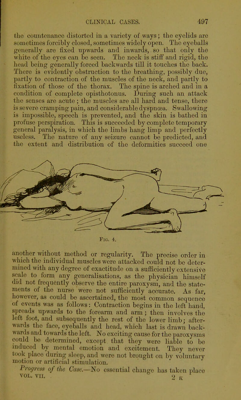 the countenance distorted in a variety of ways; the eyelids are sometimes forcibly closed, sometimes widely open. The eyeballs generally are fixed upwards and inwards, so that only the white of the eyes can be seen. The neck is stiff and rigid, the head being generally forced backwards till it touches the back. There is evidently obstruction to the breathing, possibly due, partly to contraction of the muscles of the neck, and partly to fixation of those of the thorax. The spine is arched and in a condition of complete opisthotonus. During such an attack the senses are acute; the muscles are all hard and tense, there is severe cramping pain, and considerable dyspnoea. Swallowing is impossible, speech is prevented, and the skin is bathed in profuse perspiration. This is succeeded by complete temporary general paralysis, in which the limbs hang limp and perfectly useless. The nature of any seizure cannot be predicted, and the extent and distribution of the deformities succeed one Fig. 4. another without method or regularity. The precise order in which the individual muscles were attacked could not be deter- mined with any degree of exactitude on a sufficiently extensive scale to form any generalisations, as the physician himself did not frequently observe the entire paroxysm, and the state- ments of the nurse were not sufficiently accurate. As far, however, as could be ascertained, the most common sequence of events was as follows: Contraction begins in the left hand, spreads upwards to the forearm and arm ; then involves the left foot, and subsequently the rest of the lower limb; after- wards the face, eyeballs and head, which last is drawn back- wards and towards the left. No exciting cause for the paroxysms could be determined, except that they were liable to be induced by mental emotion and excitement. They never took place during sleep, and were not brought on by voluntary motion or artificial stimulation. Progress of the Case—No essential change has taken iilace VOL. VII.  2 K