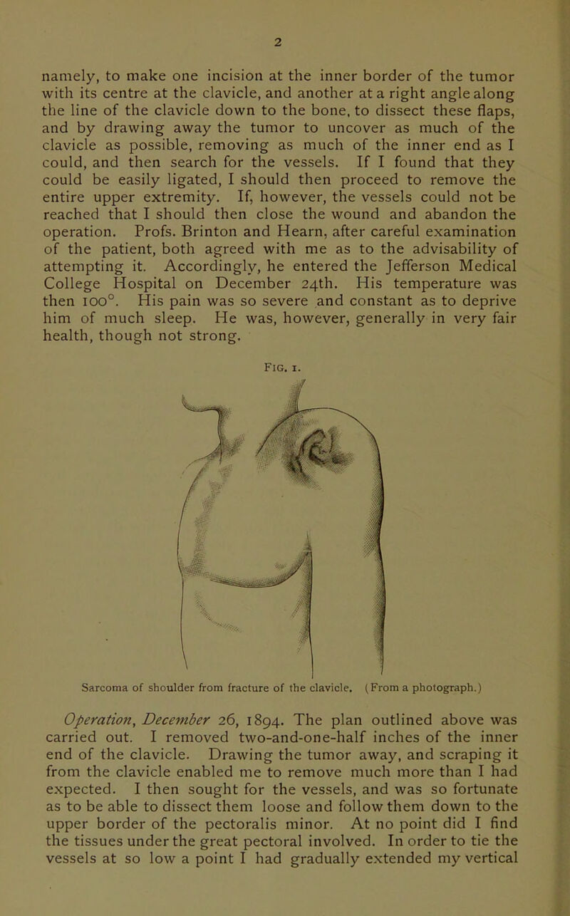 namely, to make one incision at the inner border of the tumor with its centre at the clavicle, and another at a right angle along the line of the clavicle down to the bone, to dissect these flaps, and by drawing away the tumor to uncover as much of the clavicle as possible, removing as much of the inner end as I could, and then search for the vessels. If I found that they could be easily ligated, I should then proceed to remove the entire upper extremity. If, however, the vessels could not be reached that I should then close the wound and abandon the operation. Profs. Brinton and Hearn, after careful examination of the patient, both agreed with me as to the advisability of attempting it. Accordingly, he entered the Jefferson Medical College Hospital on December 24th. His temperature was then 100°. His pain was so severe and constant as to deprive him of much sleep. He was, however, generally in very fair health, though not strong. Fig. I. Sarcoma of shoulder from fracture of the clavicle, (From a photograph.) Operation, December 26, 1894. The plan outlined above was carried out. I removed two-and-one-half inches of the inner end of the clavicle. Drawing the tumor away, and scraping it from the clavicle enabled me to remove much more than I had expected. I then sought for the vessels, and was so fortunate as to be able to dissect them loose and follow them down to the upper border of the pectoralis minor. At no point did I find the tissues under the great pectoral involved. In order to tie the vessels at so low a point I had gradually extended my vertical