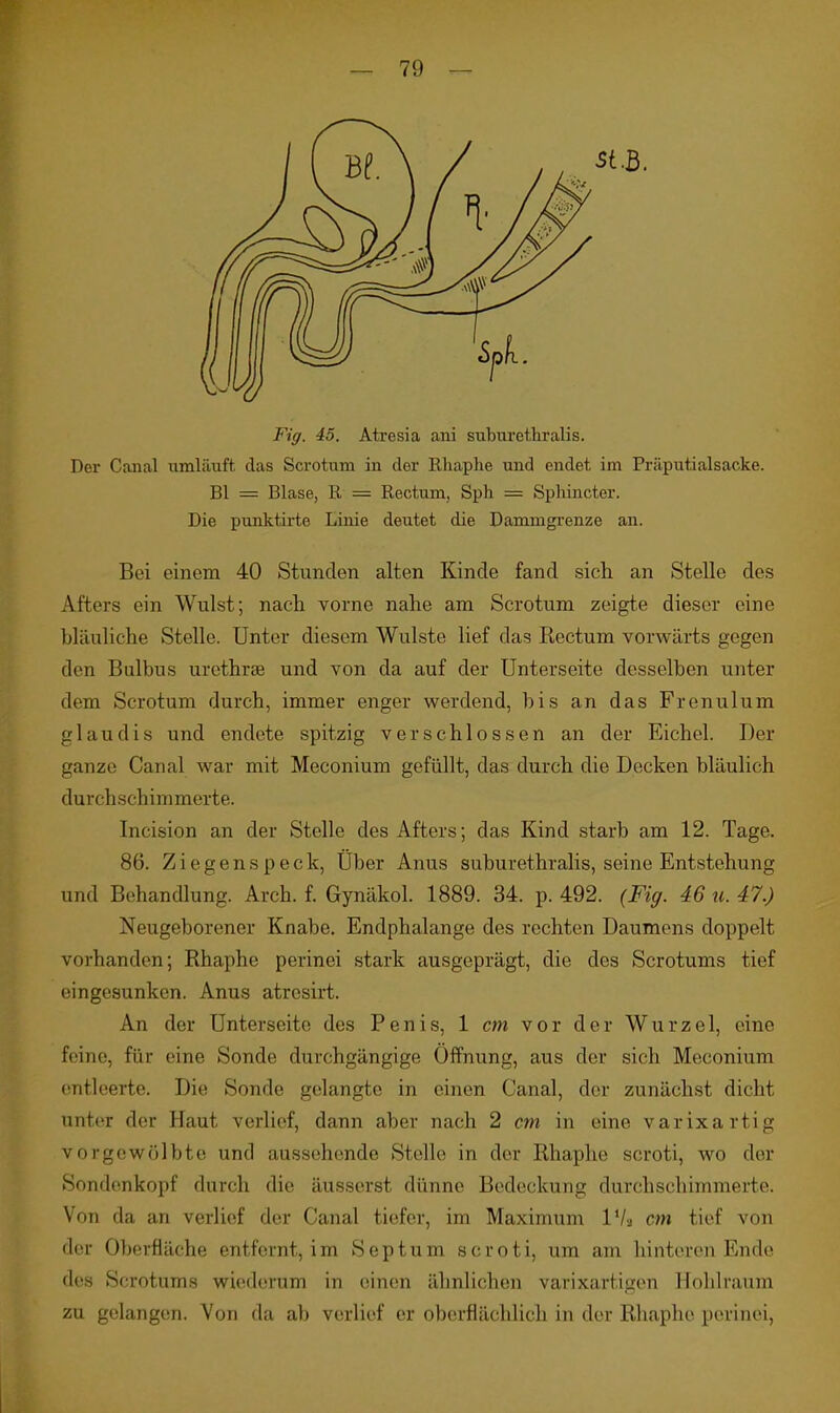 Der Canal umläuft das Scrotum in der Rhaphe und endet im Präputialsacke. Bl = Blase, R = Rectum, Sph = Spliincter. Die punktirte Linie deutet die Dammgrenze an. Bei einem 40 Stunden alten Kinde fand sich an Stelle des Afters ein Wulst; nach vorne nahe am Scrotum zeigte dieser eine bläuliche Stelle. Unter diesem Wulste lief das Eectum vorwärts gegen den Bulbus urcthrae und von da auf der Unterseite desselben unter dem Scrotum durch, immer enger werdend, bis an das Frenulum glaudis und endete spitzig verschlossen an der Eichel. Der ganze Canal war mit Meconium gefüllt, das durch die Decken bläulich durchschimmerte. Incision an der Stelle des Afters; das Kind starb am 12. Tage. 86. Z i e g e n s p e c k, Uber Anus suburethralis, seine Entstehung und Behandlung. Arch. f. Gynäkol. 1889. 34. p. 492. (Fig. 46 u. 47.) Neugeborener Knabe. Endphalange des rechten Daumens doppelt vorhanden; Rhaphe perinei stark ausgeprägt, die des Scrotums tief eingesunken. Anus atresirt. An der Unterseite des Penis, 1 cm vor der Wurzel, eine feine, für eine Sonde durchgängige Öffnung, aus der sich Meconium (mtleerte. Die Sonde gelangte in einen Canal, der zunächst dicht unter der Haut verlief, dann aber nach 2 cm in eine varixartig vorgewölbte und aussehende Stelle in der Rhaphe scroti, wo der Sondenkopf durch die äusserst dünne Bedeckung durchschimmerte. Von da an verlief der Canal tiefer, im Maximum IVa cm tief von der Oberfläche entfernt, im Septum scroti, um am hinteren Ende des Scrotums wiederum in einen ähnlichen varixartigen Hohlraum zu gelangen. Von da ab verlief er oberflächlich in der Rhaphe perinei,