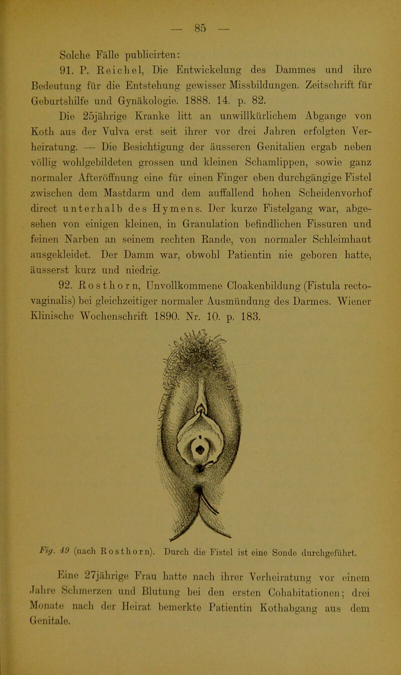 Solche Fälle publicirten: 91. P. Reichel, Die Entwickelung des Dammes und ihre Bedeutung für die Entstehung gewisser Missbildungcn. Zeitschrift für Geburtshilfe und Gynäkologie. 1888. 14. p. 82. Die 2öjährige Kranke litt an unwillkürlichem Abgange von Koth aus der Vulva erst seit ihrer vor drei Jahren erfolgten Ver- heiratung. — Die Besichtigung der äusseren Genitalien ergab neben völlig wohlgebildeten grossen und kleinen Schamlippen, sowie ganz normaler Afteröftnung eine für einen Finger eben durchgängige Fistel zwischen dem Mastdarm und dem auffallend hohen Scheidenvorhof direct unterhalb des Hymens. Der kurze Fistelgang war, abge- sehen von einigen kleinen, in Granulation befindlichen Fissuren und feinen Narben an seinem rechten Rande, von normaler Schleimhaut aiisgekleidet. Der Damm war, obwohl Patientin nie geboren hatte, äusserst kurz und niedrig. 92. R 0 s t h 0 r n, Unvollkommene Cloakenbildung (Fistula recto- vaginalis) bei gleichzeitiger normaler Ausmündung des Darmes. Wiener KUnische Wochenschrift 1890. Nr. 10. p. 183. Fig. 49 (nach Rosthorn). Durch clie Fistel ist eine Sonde diu-chgefiihrt. Eine 27jährige Fiau hatte nach ihrer Verheiratung vor einem Jahre Schmerzen und Blutung bei den ersten Cohabitationen; drei Monate nach der Heirat bemerkte Patientin Kothabgang aus dem Genitale.
