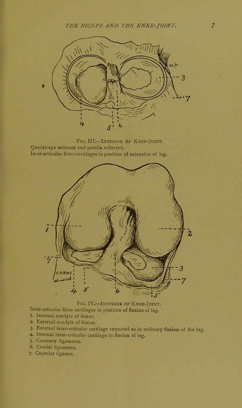 Fig. IV.—Intfrior of Knee-Joint. Inter-articular fibro cartilages in position of flexion of leg. 1. Internal condyle of femur. 2. External condyle of femur. 3. External inter-articular cartilage retracted as in ordinary flexion of the leg. 4. Internal inter-articular cartilage in flexion of leg. 5. Coronary ligaments. 6. Crucial ligaments. 7. Capsular ligamet.