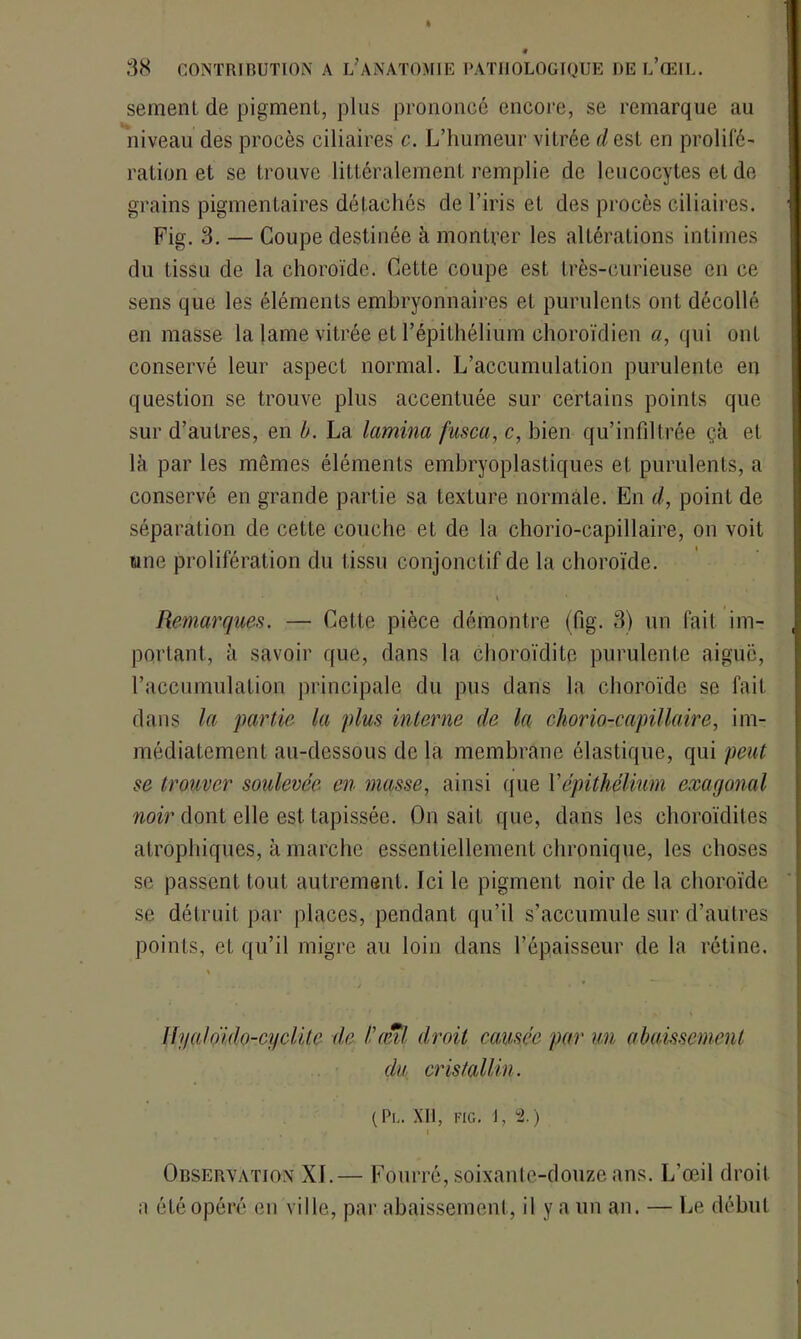 sement de pigment, plus prononcé encore, se remarque au niveau des procès ciliaires c. L’humeur vitrée cl est en prolifé- ration et se trouve littéralement remplie de leucocytes et de grains pigmentaires détachés de l’iris et des procès ciliaires. Fig. 3. — Coupe destinée à montrer les altérations intimes du tissu de la choroïde. Cette coupe est très-curieuse en ce sens que les éléments embryonnaires et purulents ont décollé en masse la lame vitrée et l’épithélium choroïdien a, qui ont conservé leur aspect normal. L’accumulation purulente en question se trouve plus accentuée sur certains points que sur d’autres, en b. La lamina fusca, c, bien qu’infiltrée çà et là par les mêmes éléments embryoplastiques et purulents, a conservé en grande partie sa texture normale. En cl, point de séparation de cette couche et de la chorio-capillaire, on voit une prolifération du tissu conjonctif de la choroïde. t \ ' Remarques. — Cette pièce démontre (fig. 3) un fait im- portant, à savoir que, dans la choroïdite purulente aiguë, l’accumulation principale du pus dans la choroïde se fait dans la partie la plus interne de la chorio-capillaire, im- médiatement au-dessous de la membrane élastique, qui peut se trouver soulevée en masse, ainsi que Xépithélium exagonal noir dont elle est tapissée. On sait que, dans les choroïdites atrophiques, à marche essentiellement chronique, les choses se passent tout autrement. Ici le pigment noir de la choroïde se détruit par places, pendant qu’il s’accumule sur d’autres points, et qu’il migre au loin dans l’épaisseur de la rétine. Ih/aloïdo-cyclite de l'eut droit camée par un abaissement du cristallin. (PL. XII, FIG. J, 2.) , , i Observation XJ.— Fourré, soixante-douze ans. L’œil droit a été opéré en ville, par abaissement, il y a un an. — Le début