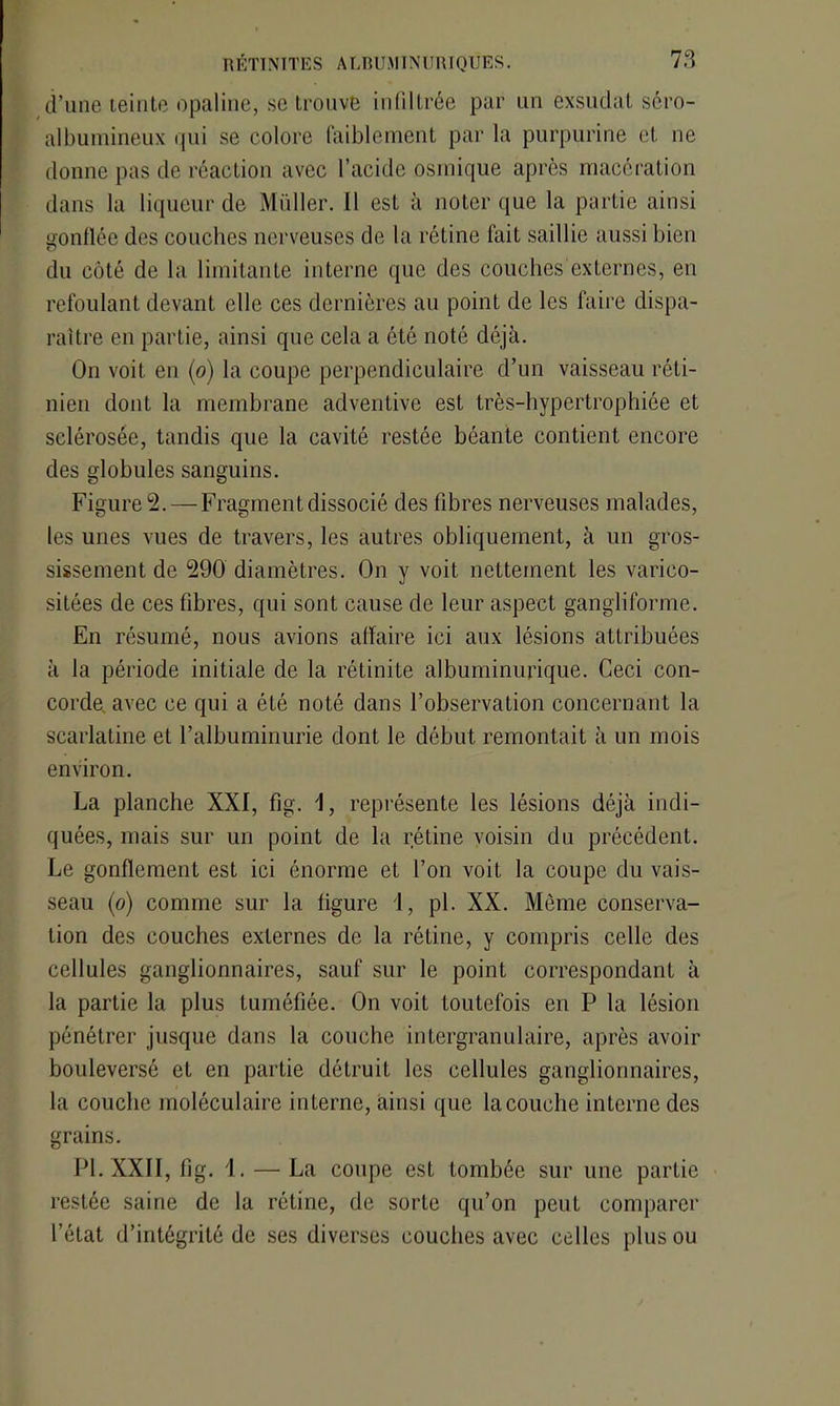 d’une teinte opaline, se trouve infiltrée par un exsudât séro- albumineux qui se colore faiblement par la purpurine et ne donne pas de réaction avec l’acide osmique après macération dans la liqueur de Müller. 11 est à noter que la partie ainsi gonflée des couches nerveuses de la rétine fait saillie aussi bien du côté de la limitante interne que des couches externes, en refoulant devant elle ces dernières au point de les faire dispa- raître en partie, ainsi que cela a été noté déjà. On voit en (o) la coupe perpendiculaire d’un vaisseau réti- nien dont la membrane adventive est très-hypertrophiée et sclérosée, tandis que la cavité restée béante contient encore des globules sanguins. FigureS. — Fragment dissocié des fibres nerveuses malades, les unes vues de travers, les autres obliquement, à un gros- sissement de 290 diamètres. On y voit nettement les varico- sitées de ces fibres, qui sont cause de leur aspect gangliforme. En résumé, nous avions affaire ici aux lésions attribuées à la période initiale de la rétinite albuminurique. Ceci con- corde avec ce qui a été noté dans l’observation concernant la scarlatine et l’albuminurie dont le début remontait à un mois environ. La planche XXI, fig. 1, représente les lésions déjà indi- quées, mais sur un point de la rétine voisin du précédent. Le gonflement est ici énorme et l’on voit la coupe du vais- seau (o) comme sur la figure 1, pi. XX. Même conserva- tion des couches externes de la rétine, y compris celle des cellules ganglionnaires, sauf sur le point correspondant à la partie la plus Luméfiée. On voit toutefois en P la lésion pénétrer jusque dans la couche intergranulaire, après avoir bouleversé et en partie détruit les cellules ganglionnaires, la couche moléculaire interne, ainsi que la couche interne des grains. PL XXII, fig. 1. — La coupe est tombée sur une partie restée saine de la rétine, de sorte qu’on peut comparer l’état d’intégrité de ses diverses couches avec celles plus ou