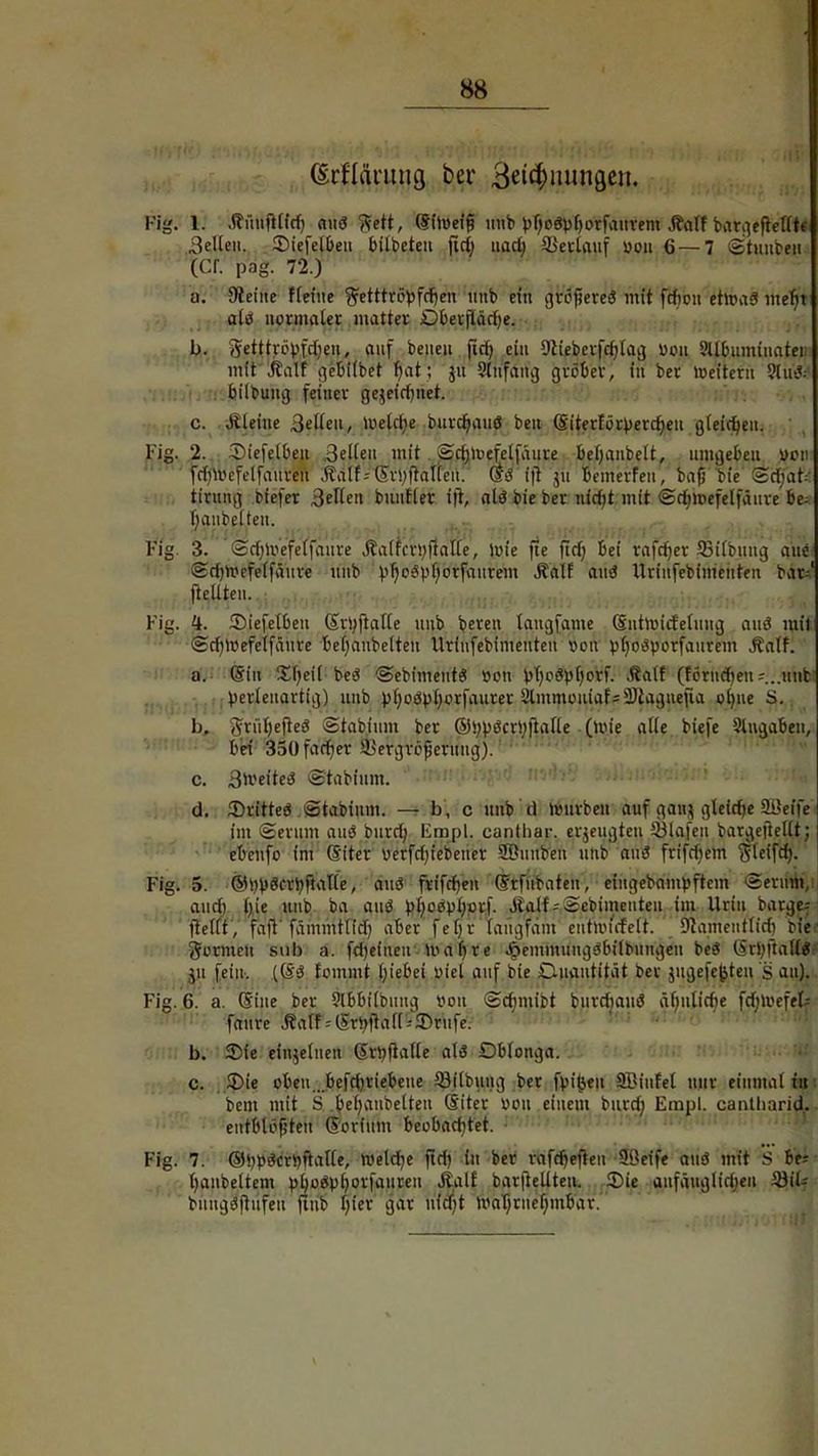 (Scflänuicj ber Betonungen. Fi«. 1. .ftünfttfrf) aiiö ftett, (Sfluefg uub vTjoöbhorfaurem ,faitf bargeftetttf Sellen. SMefelben bilbetcu fid; uadj Verlauf uou 6 — 7 Stuubeii (Cf. pag. 72.) u. JReine fleiue $etttröbfd)en ttnb ein $6$txe8 mit frfiou ehvnß metn ali? normaler matter Dberftäd)e. I). Setttrbpfdjeu, auf beueu fid) ein Otieberfcfjla^ Don Stlbumiuatei: mit kalt gebilbet bat; 511 Slnfang gröber, in ber lueitcrn 3lü& bilbung feiner gewidmet. c. steine Betten, loetclK burrfmiiö beit Giterfbrt>ercr;eu gleichen. Fig. ,2. .. Siefetbejt .Selten mit . Sd)ioefelfäure betjanbett, umgeben wen frfjWcfelfaureti Äatf-- ©v!^aUen. <$S ift ju bemerfen, bafj W <SäjaU tirung tiefer Selten buufler ift, alö bie ber nfd)t mit ©dimefelfäure be; (;anbetten. . » » - - - nMi»iifaitai*ifl friWi^MTWM Fig. 3. Sd;mefetfaure Jla(fcv!)fialte, loie fte fid) Bei rafdjer ffiitbuug aue 2rtmn'fclfäure uub p^o^vfforfaurem Äalf and Urinfebimenten bar--' Fig. H. 35iefelbeu Srtyftatle uub bereit tangfame Sntroidetung auö mit 2cb»efelfäure bet)anbetten Urinfebimenten vou ptjo^yorfaurem Jtalf. a. (Sin £f)eit beö ©ebimeut« üon bT)cövt)orf. Statt (ferneren :..ii«bi perleuartig) uub pt)oöpt)orfaurer l'tiunuMiiaf^iliaguefia ol)ue s. b. 5rü()efte3 Stabium ber ®!;pöcrl;ftatte (mie alte biefe Angaben, bei 350fachet 4>ergri'fjeruug). c. SmeitesS ©tabfum. d. iDritteö ©tabinm. — b, c uub d tvurbeu auf gaun gleiche 9i>ei*fe jm (Serum and burd) Eqopl. eantliar. erjeugten 33lafen bargefiellt; ebenfo im (fiter verfd)tebeuer SfDunbeu unb au3 frifrfjem Steifd). Fig. 5. @W$crtyfkt(e, and frifd)fit ©rfubaten, eingebampftcin ©erum,; and) t)ie uub ba and pl)odpi)m\. Äatf = ©ebimenten im Urin bärge-; ftetft, faft'fämmttid) aber fetjr faügfam e'ntroi'cfelT. Slathentlicr) bw formen snb a. fdjefueu Iva^re ^emmungöbitbuitgen beS (5r^ftal£«f Mi fein. fommt l)iebei piel auf bie Cuautitüt ber jugefefcten 's au). Fig. 6. a. (5'ine ber Slbbitbung von ©d;mibt burdiauö ä()tilidie fd;luefet= ■ r' fttitre Äat?:(5rbJhif[r*JDt\ifeV ■» b. 2Me einzelnen Srtyfklte als Obtonga. c. £>ie oben . befd)riebeue öilbung ber fyitjeu SBinfet nur einmal tu bem mit S behäufelten S'itcr von einem burd; Empl. cantharid. entblößten (Stofftön beobachtet. Fig. 7. ©typScrbnatte, Welche fid) tu ber rafeb>ften Steife aue? mit S ftt fjanbeltem p^odp^orfaiireu Jfcalf barftellteu. Sie aufäuglfcljen %SiU bungöftufeu finb tjfet gar h'fajt wahrnehmbar.